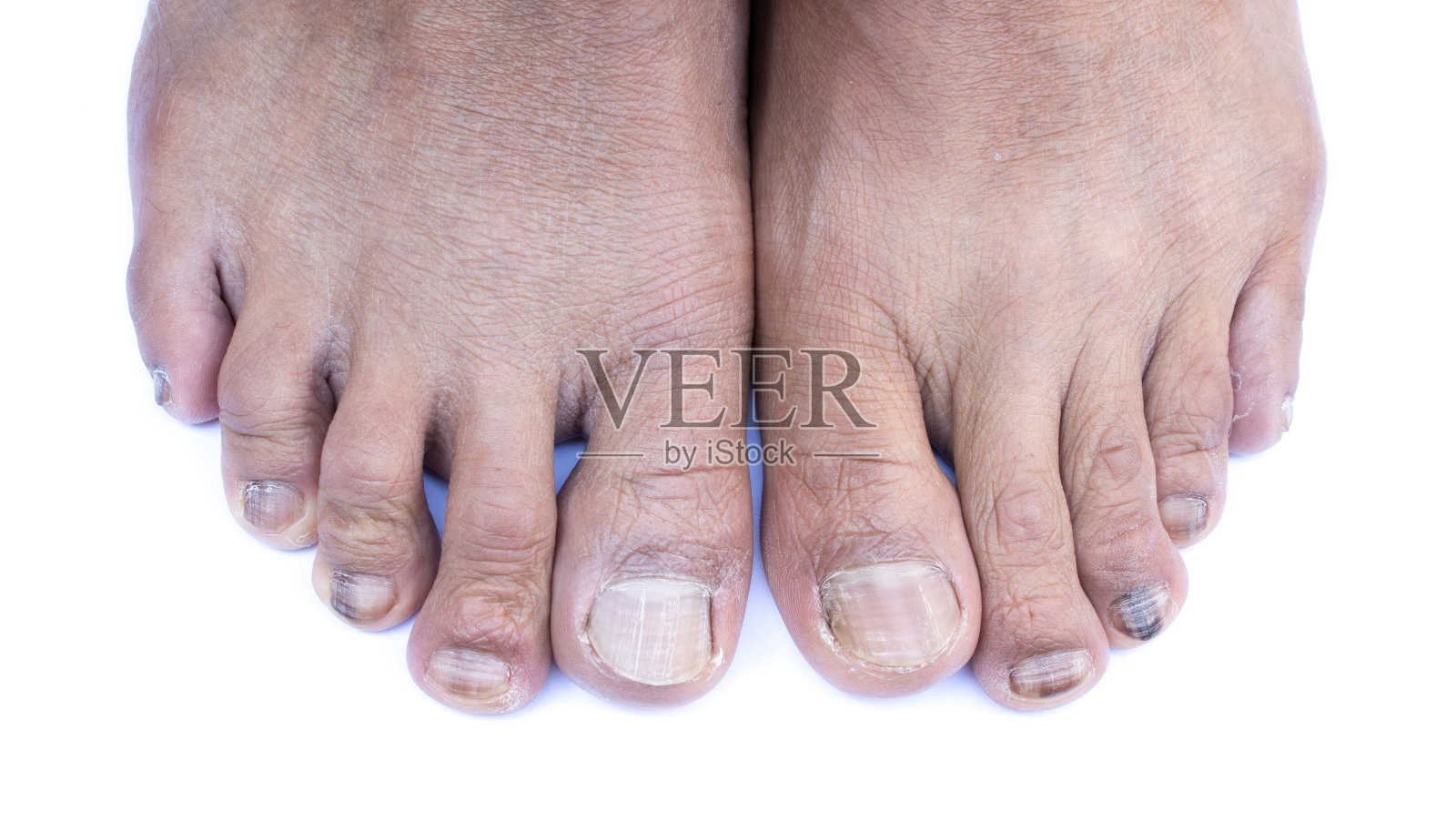 脚趾甲感染照片摄影图片