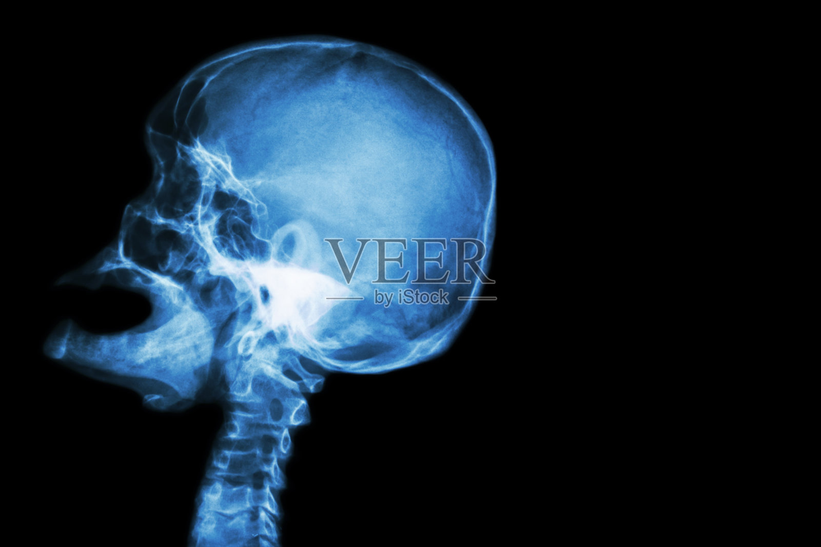 x光颅骨张开口(侧视图)和中风照片摄影图片
