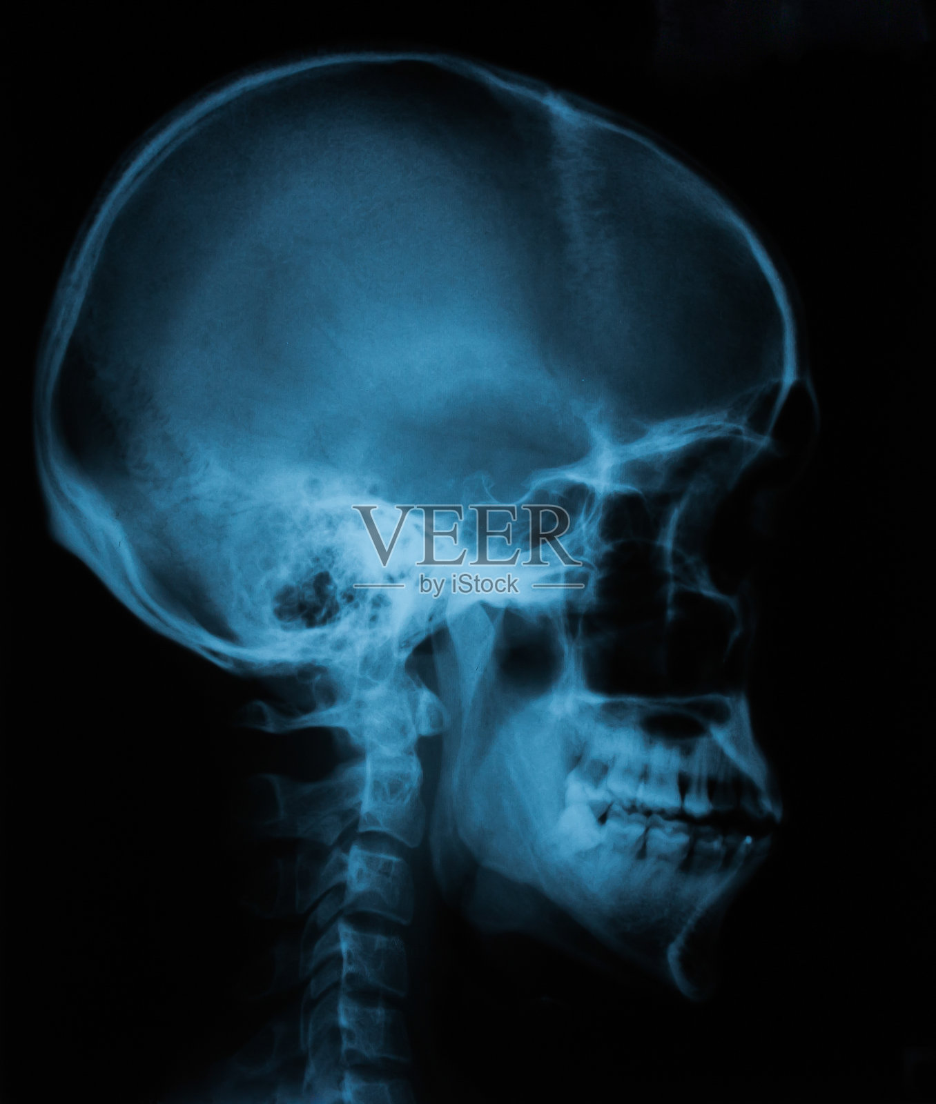 颅骨x线片,侧位片照片摄影图片