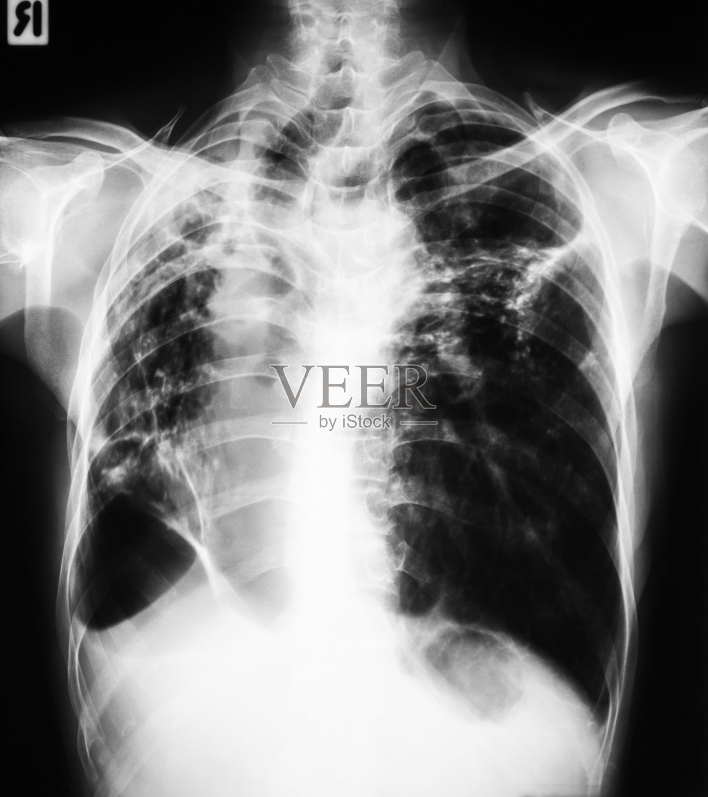 胸片PA视图显示肺结核(TB)照片摄影图片