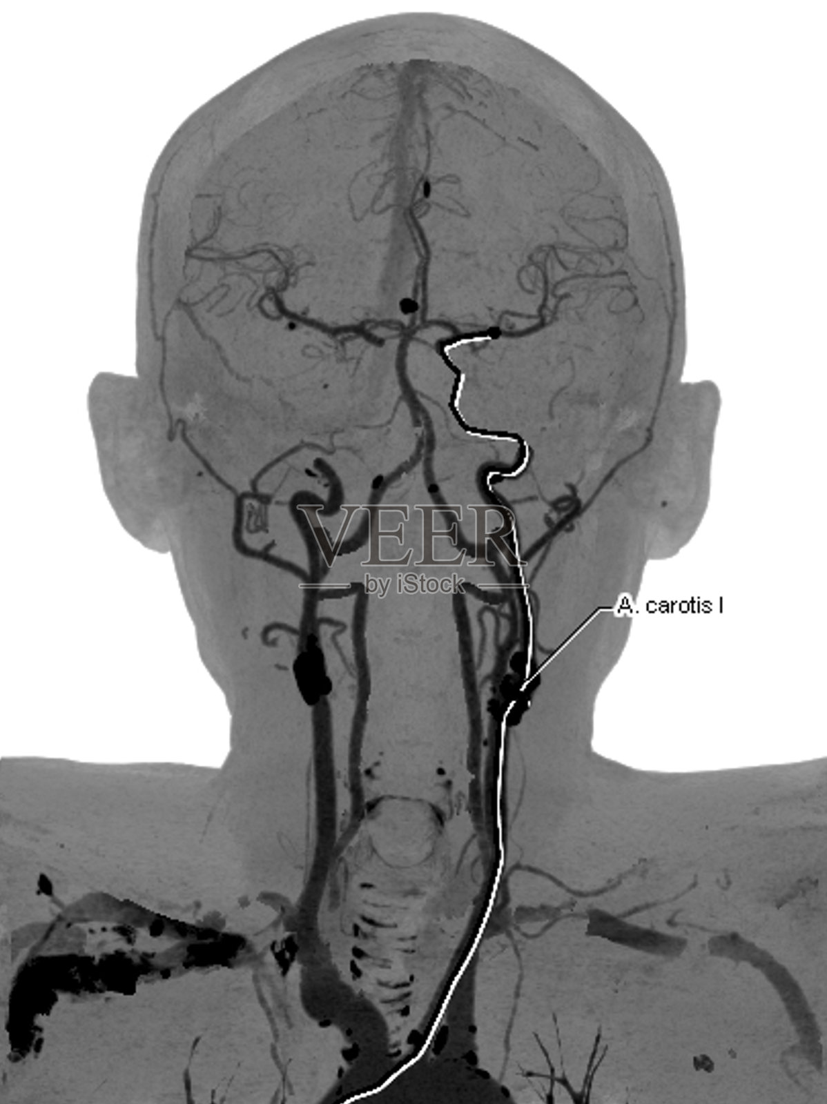 颈动脉疾病照片摄影图片