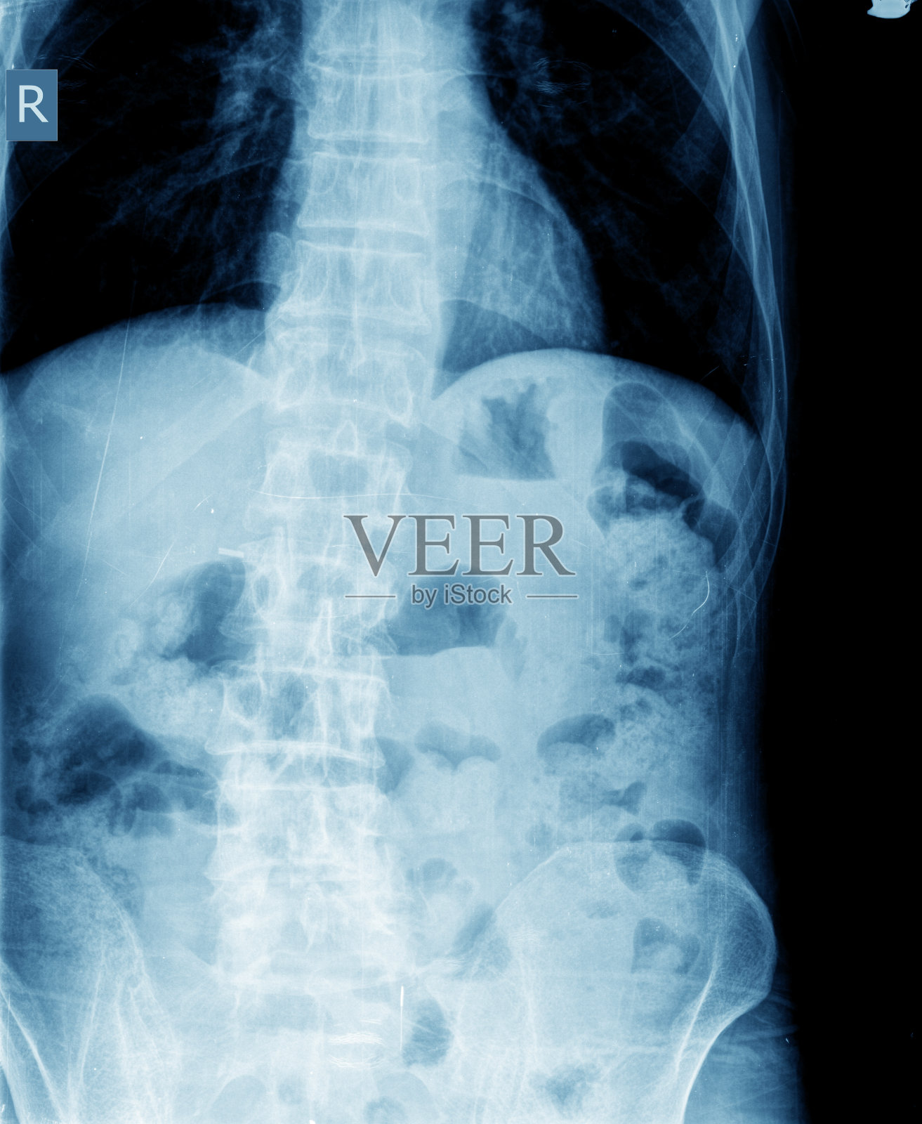 腹部x光照片摄影图片