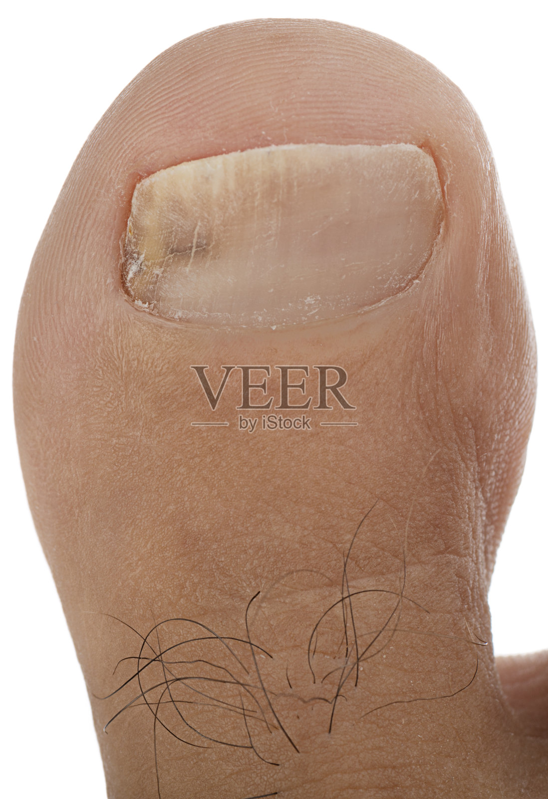 甲真菌病照片摄影图片