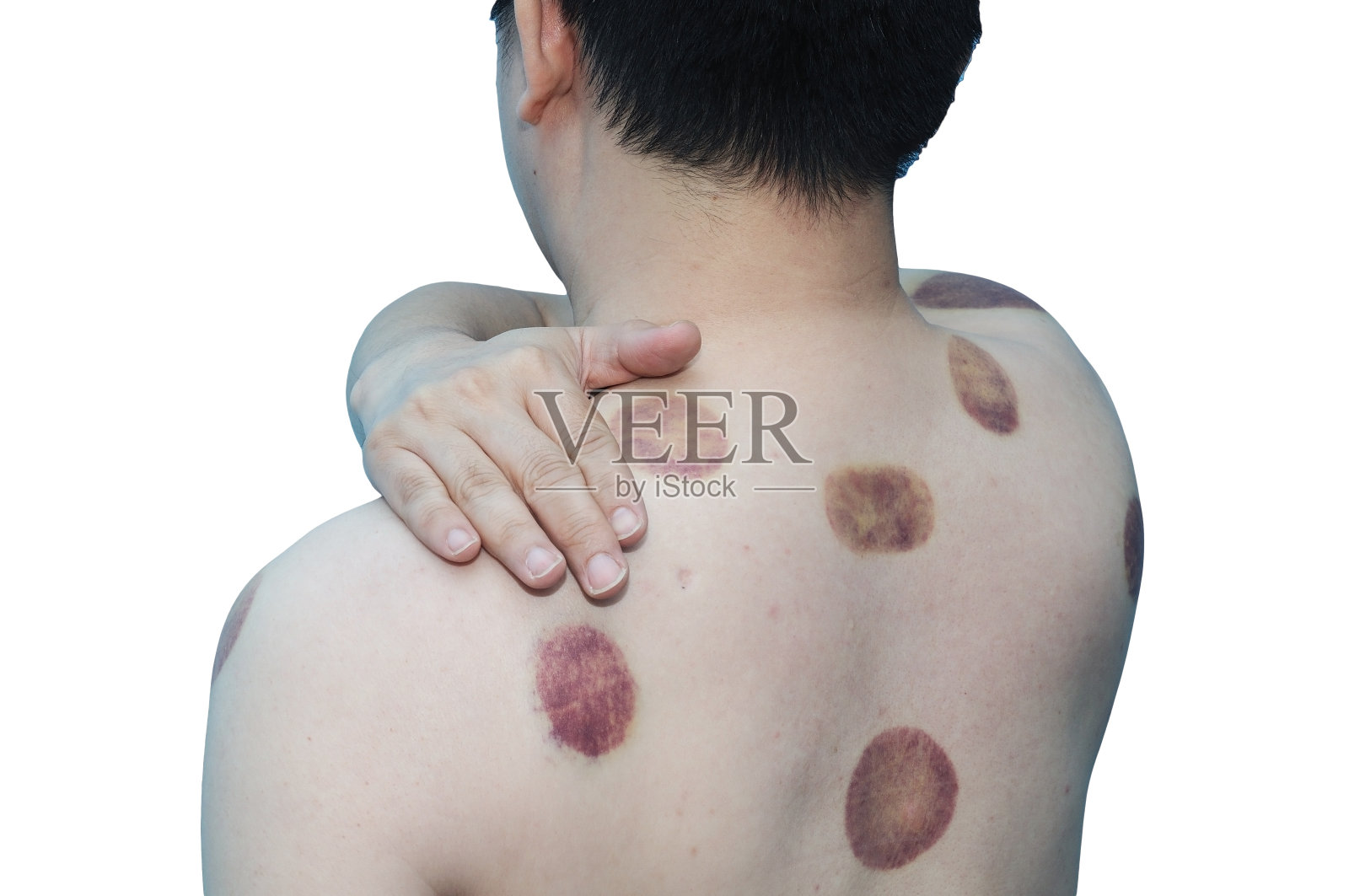 亚洲男子,43岁,有拔火罐的痕迹照片摄影图片