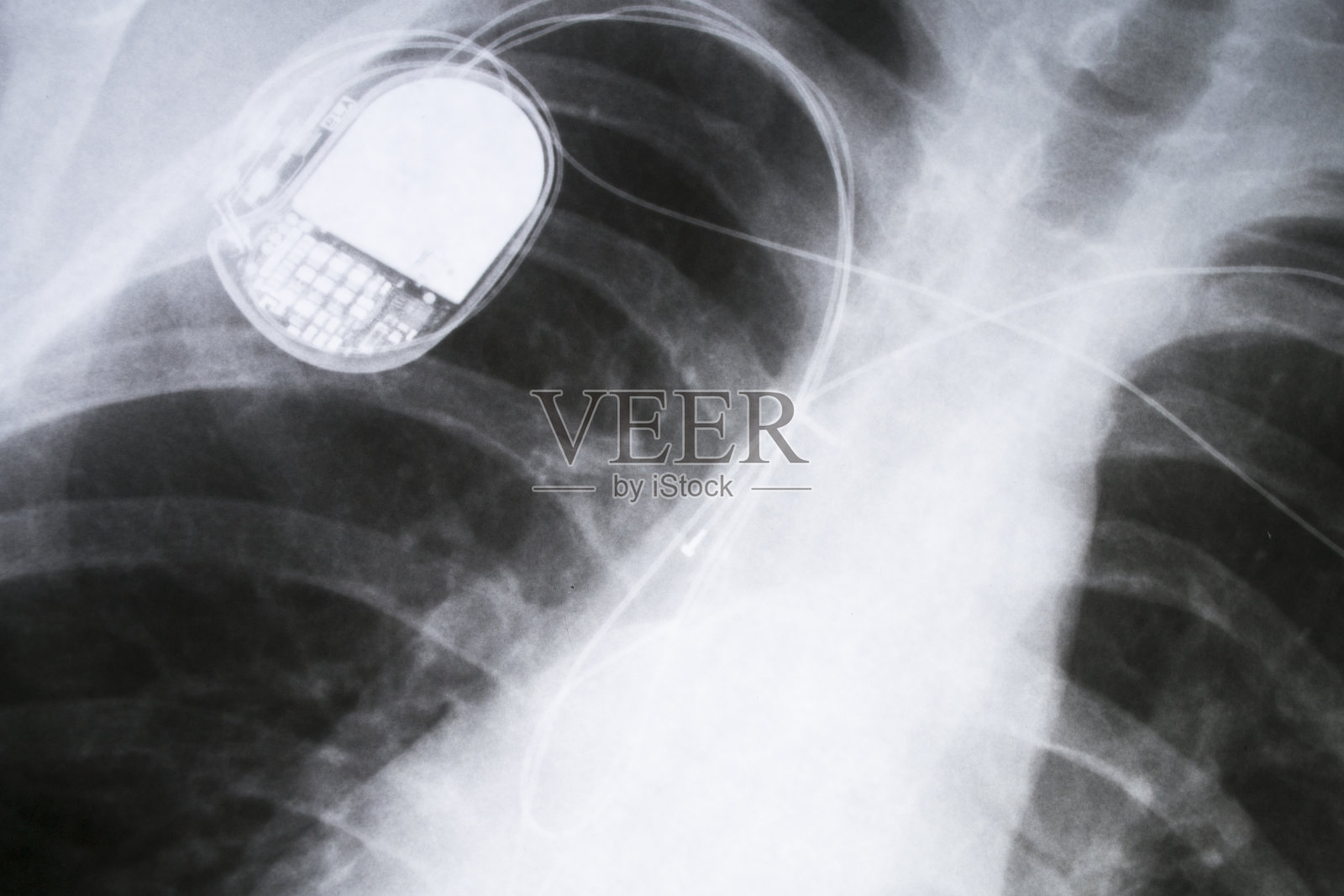 x射线的胸部照片摄影图片