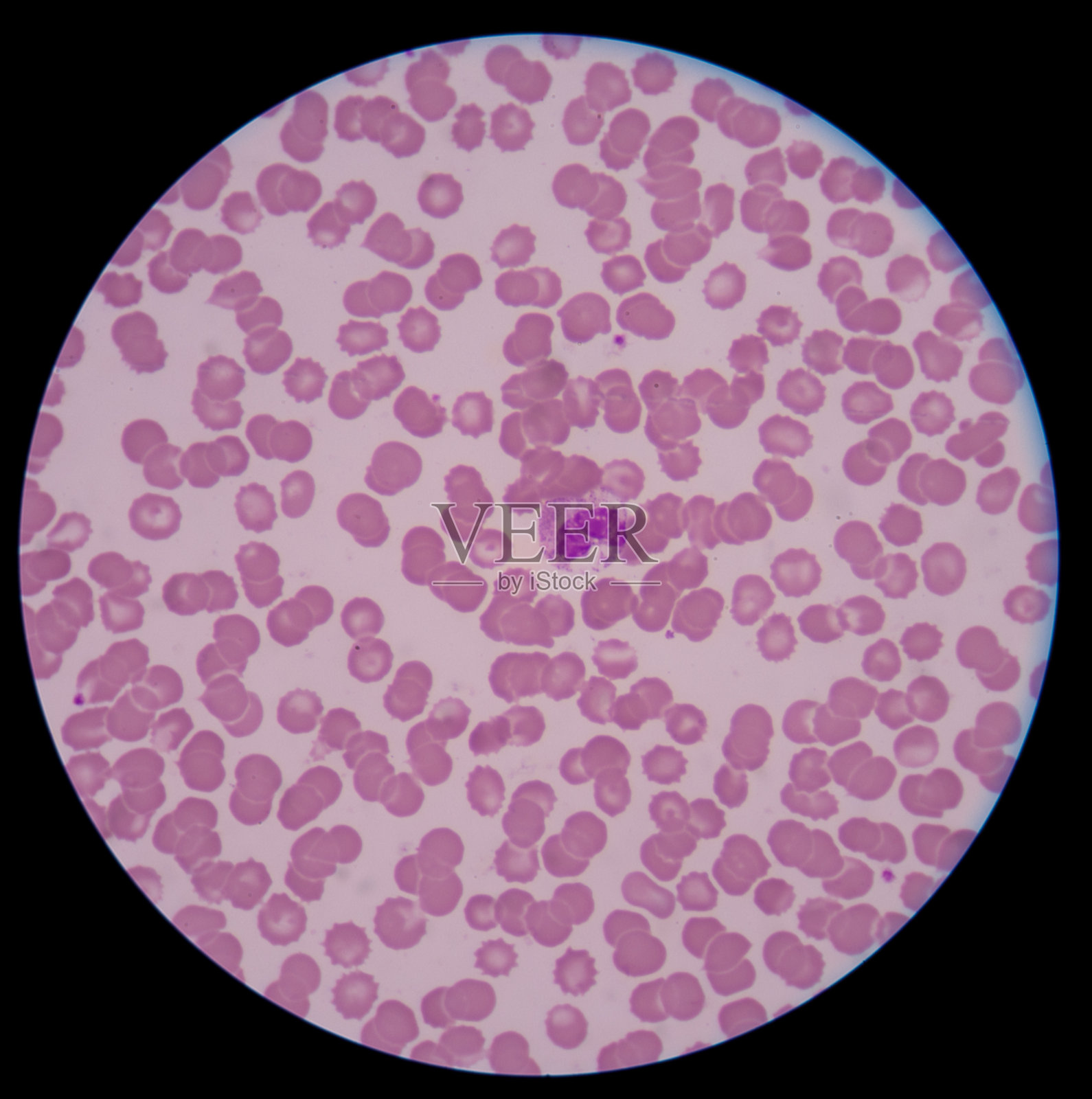 嗜中性粒细胞异常。照片摄影图片