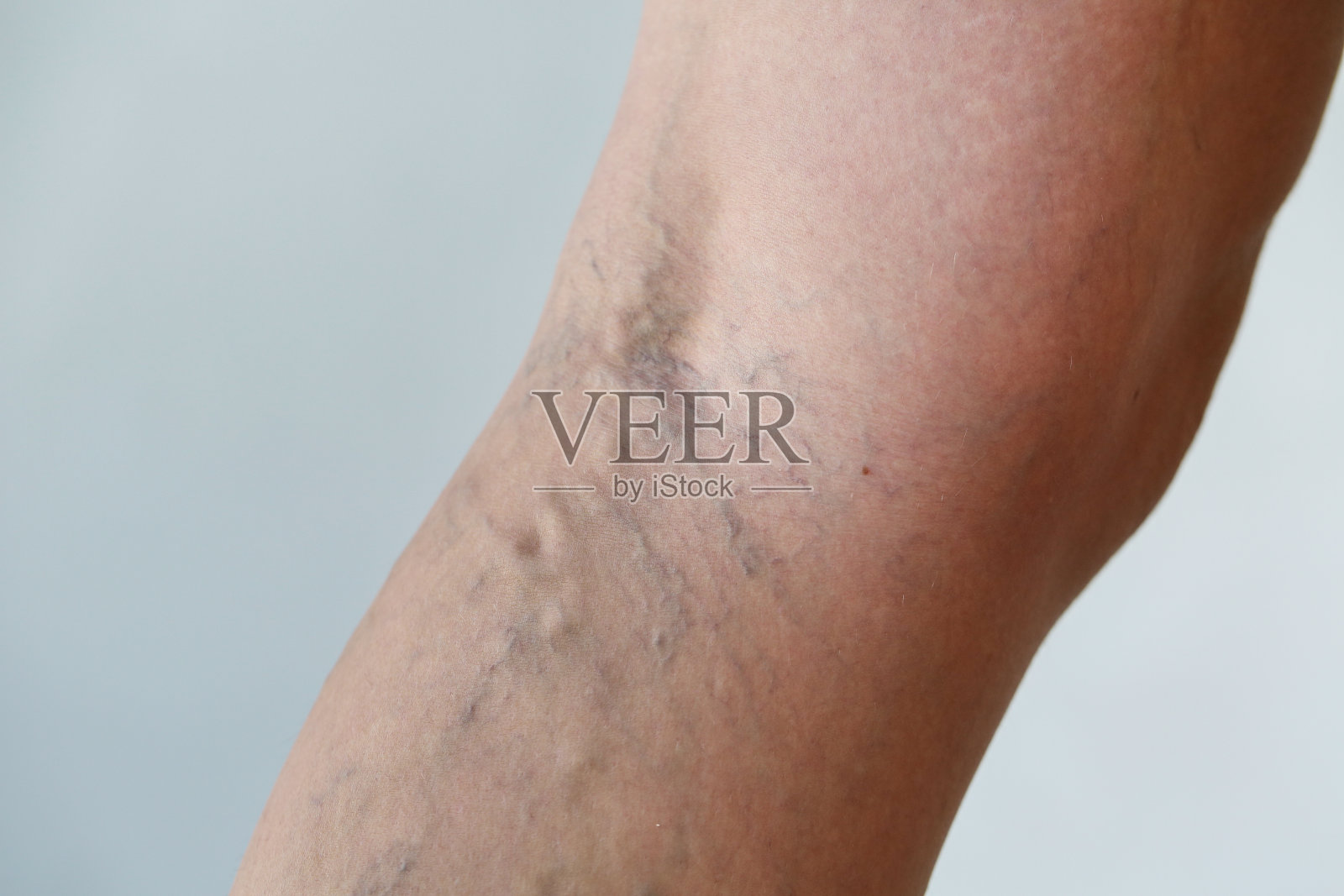 静脉曲张照片摄影图片