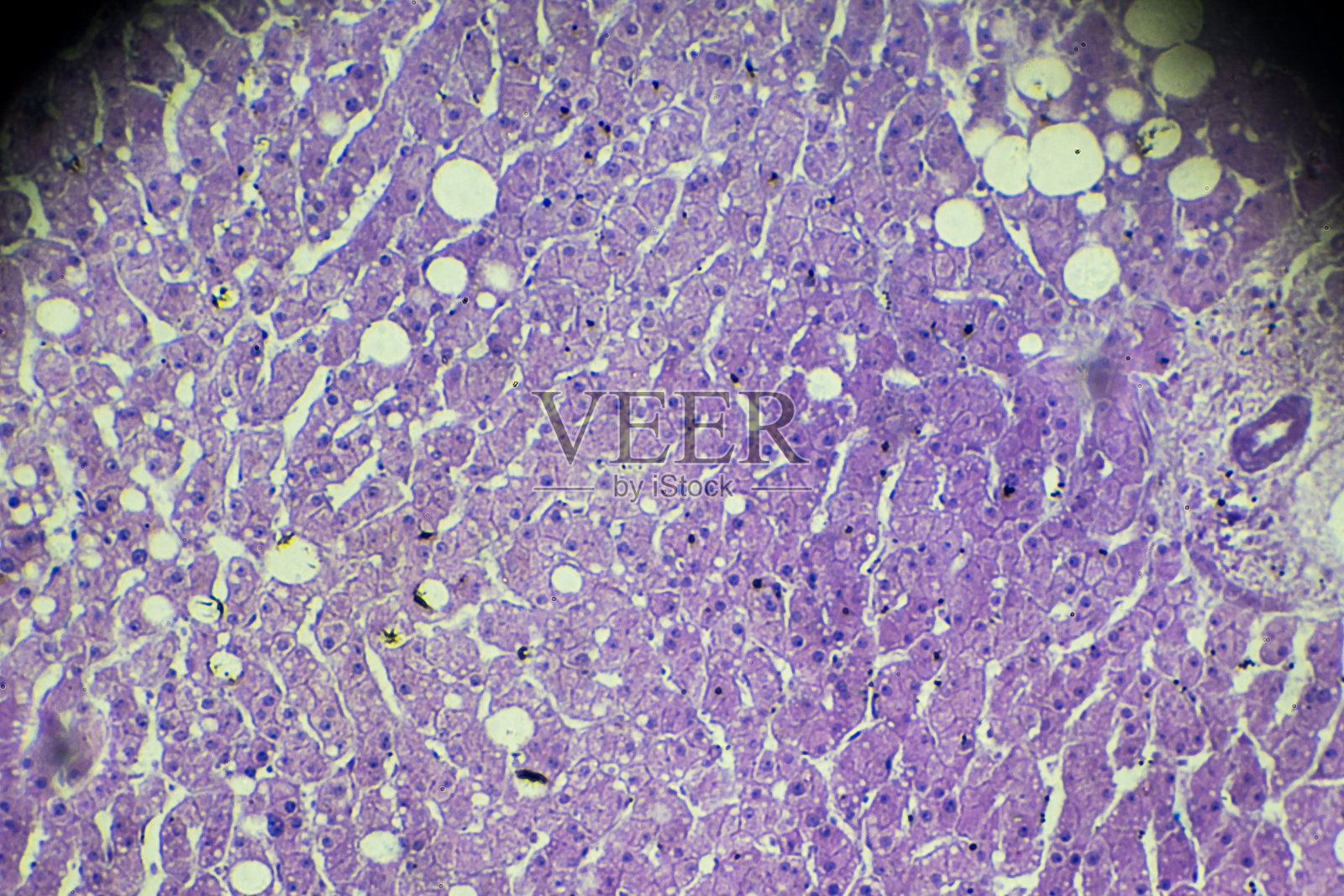 显微镜下肝脏脂肪变性照片摄影图片