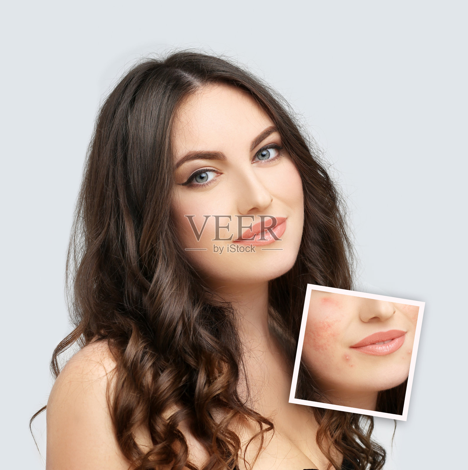 Post-Acne标志,痤疮疤痕照片摄影图片