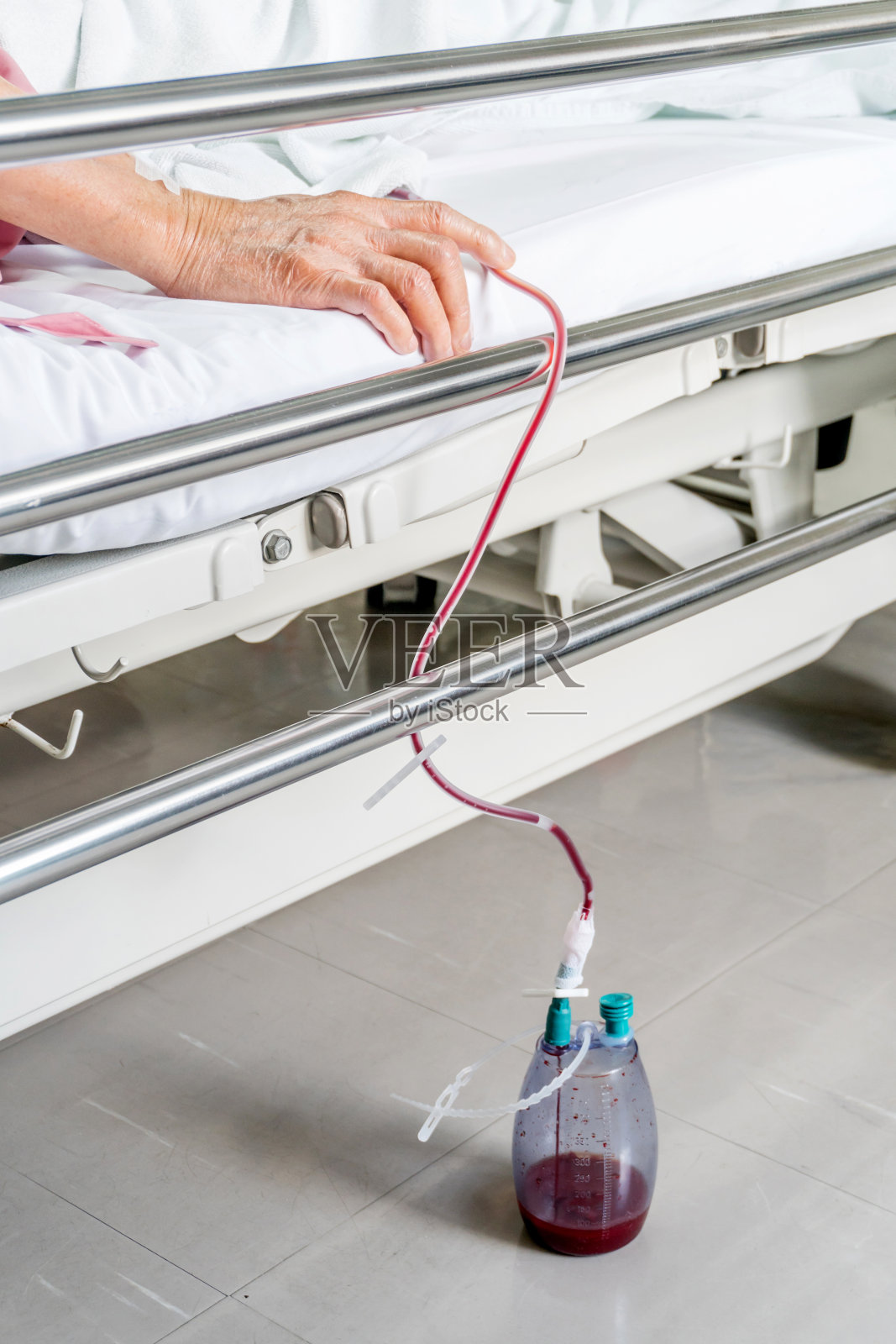 术后引流管有血。照片摄影图片