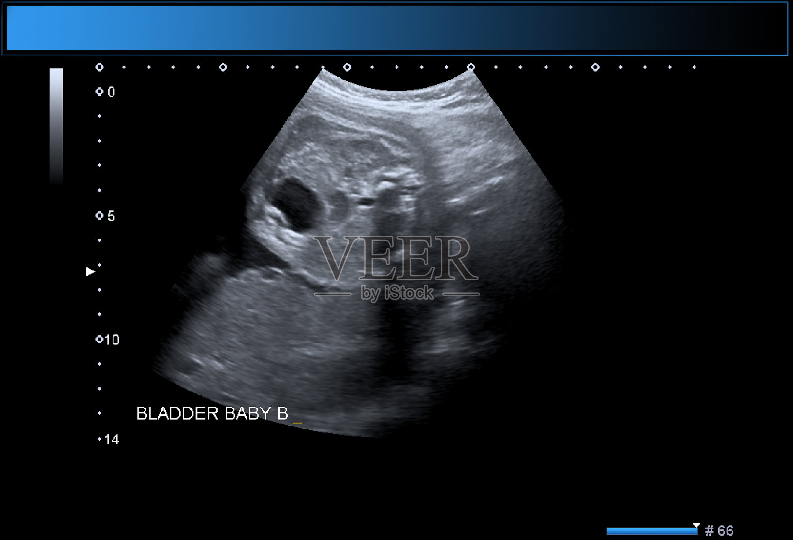 同卵双胞胎男孩产科超声照片摄影图片