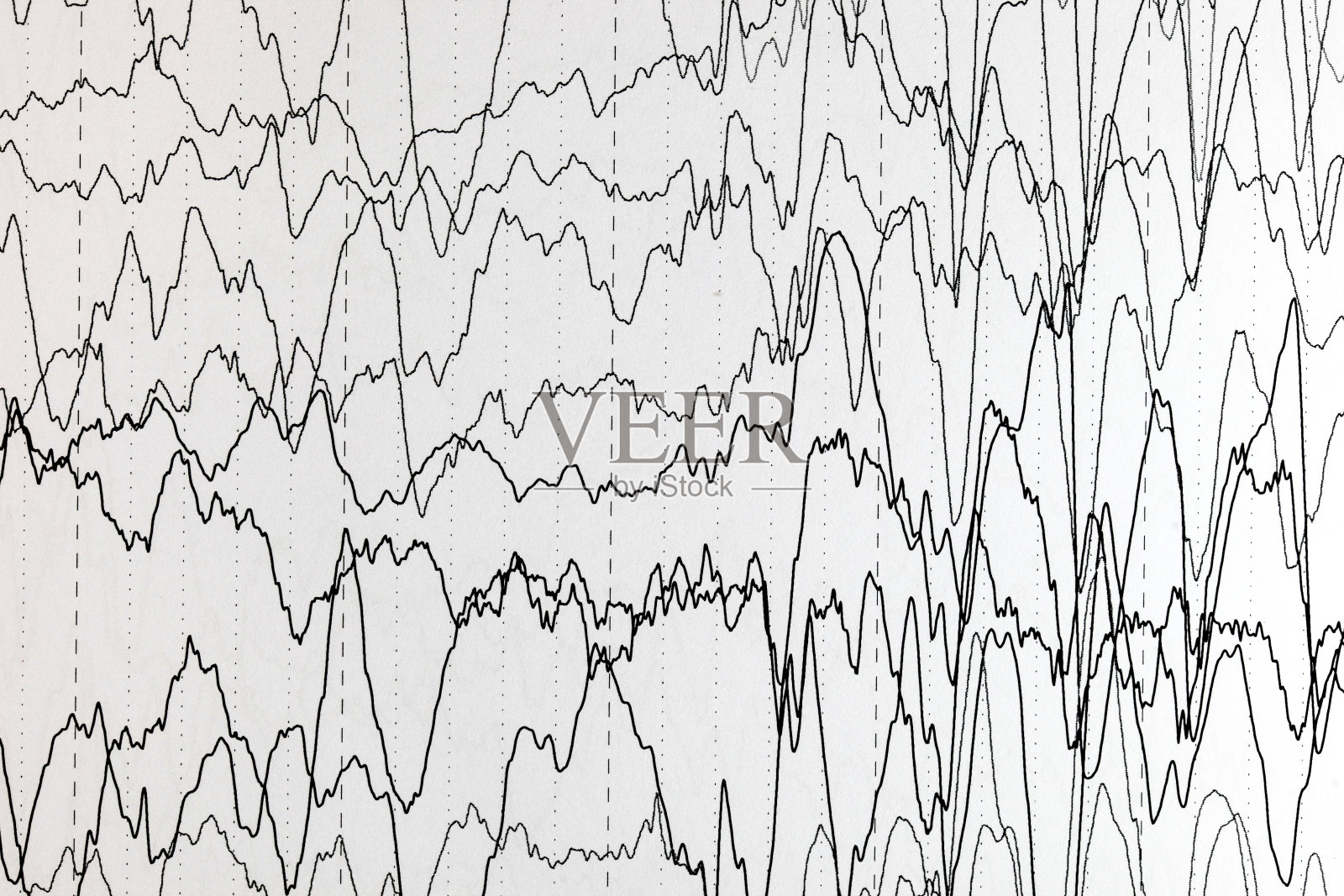 脑电图上的脑电波模式,小儿患者的脑电图,大脑电活动的问题。照片摄影图片