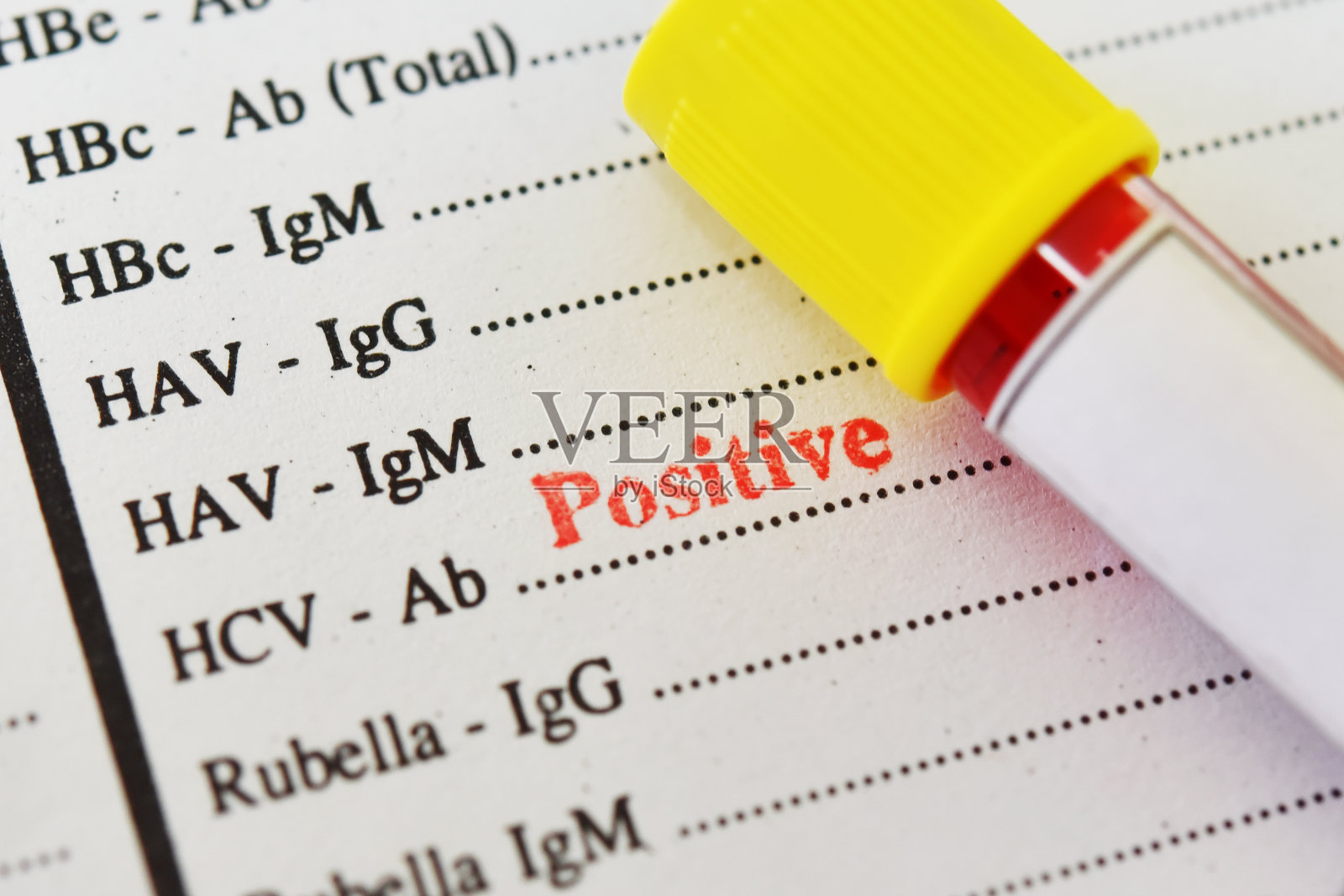 丙型肝炎病毒检测结果呈阳性照片摄影图片