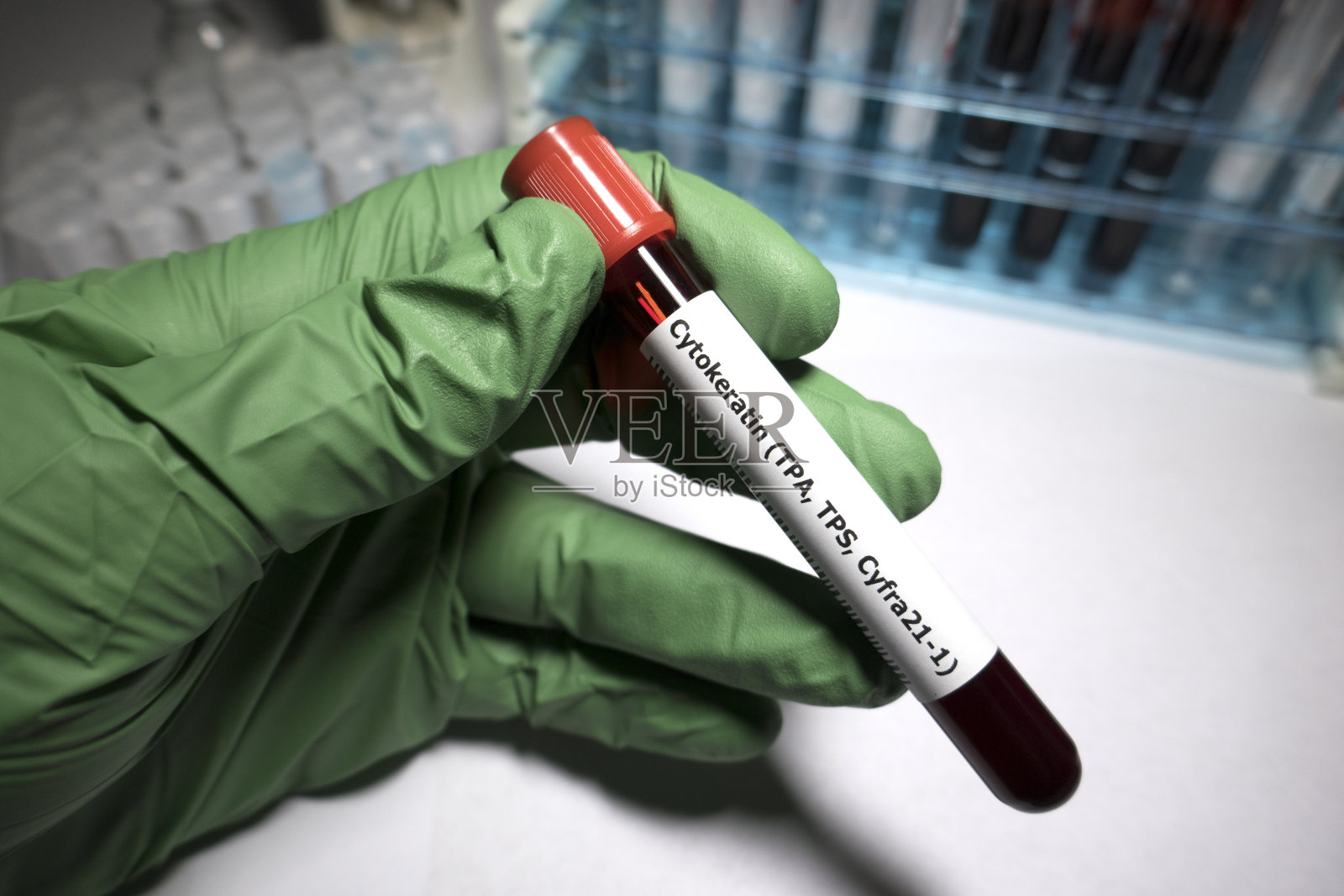 癌和肉瘤肿瘤标志物细胞角蛋白照片摄影图片