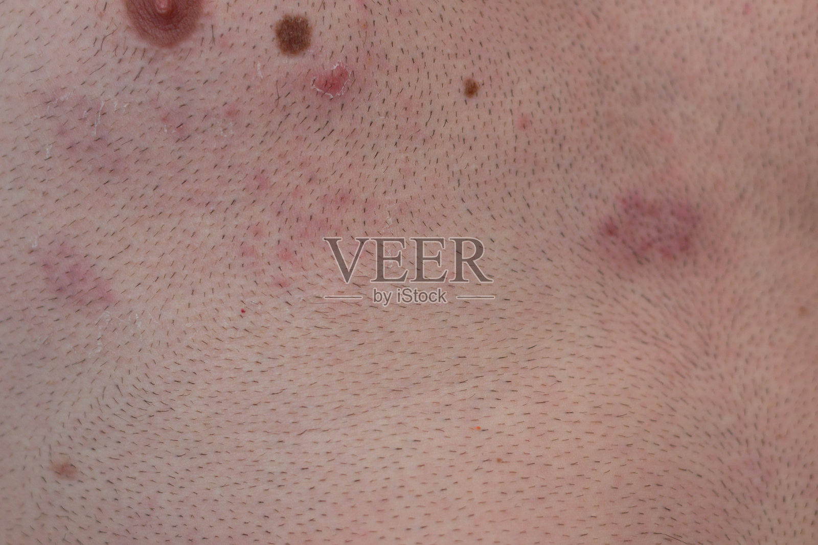 带带状疱疹感染照片摄影图片