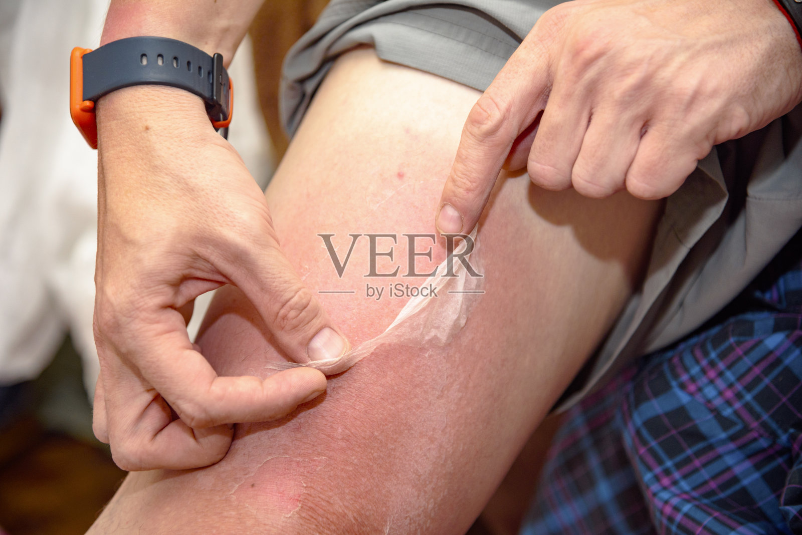 灼伤了人的皮肤照片摄影图片