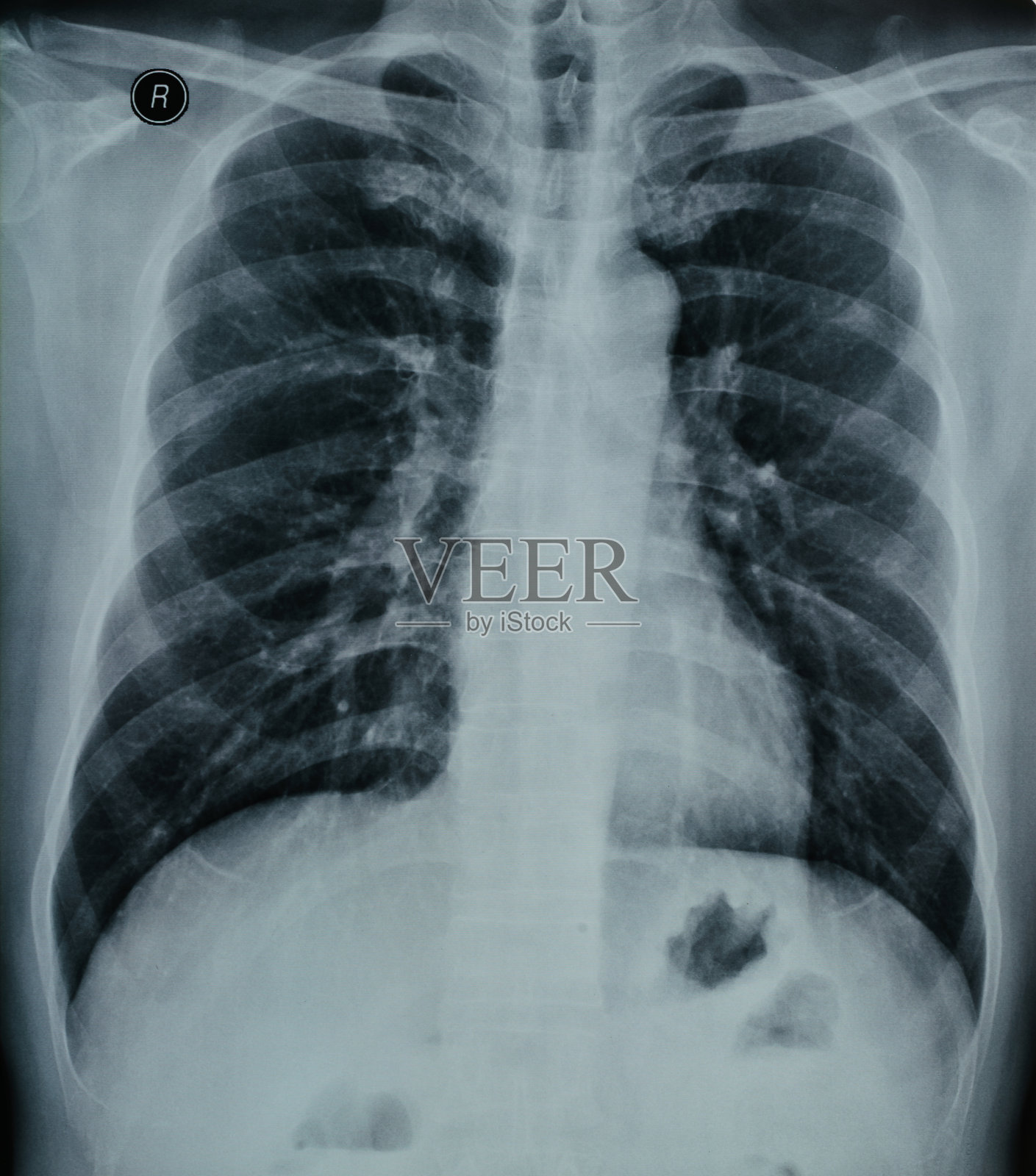 人体胸部x光片照片摄影图片