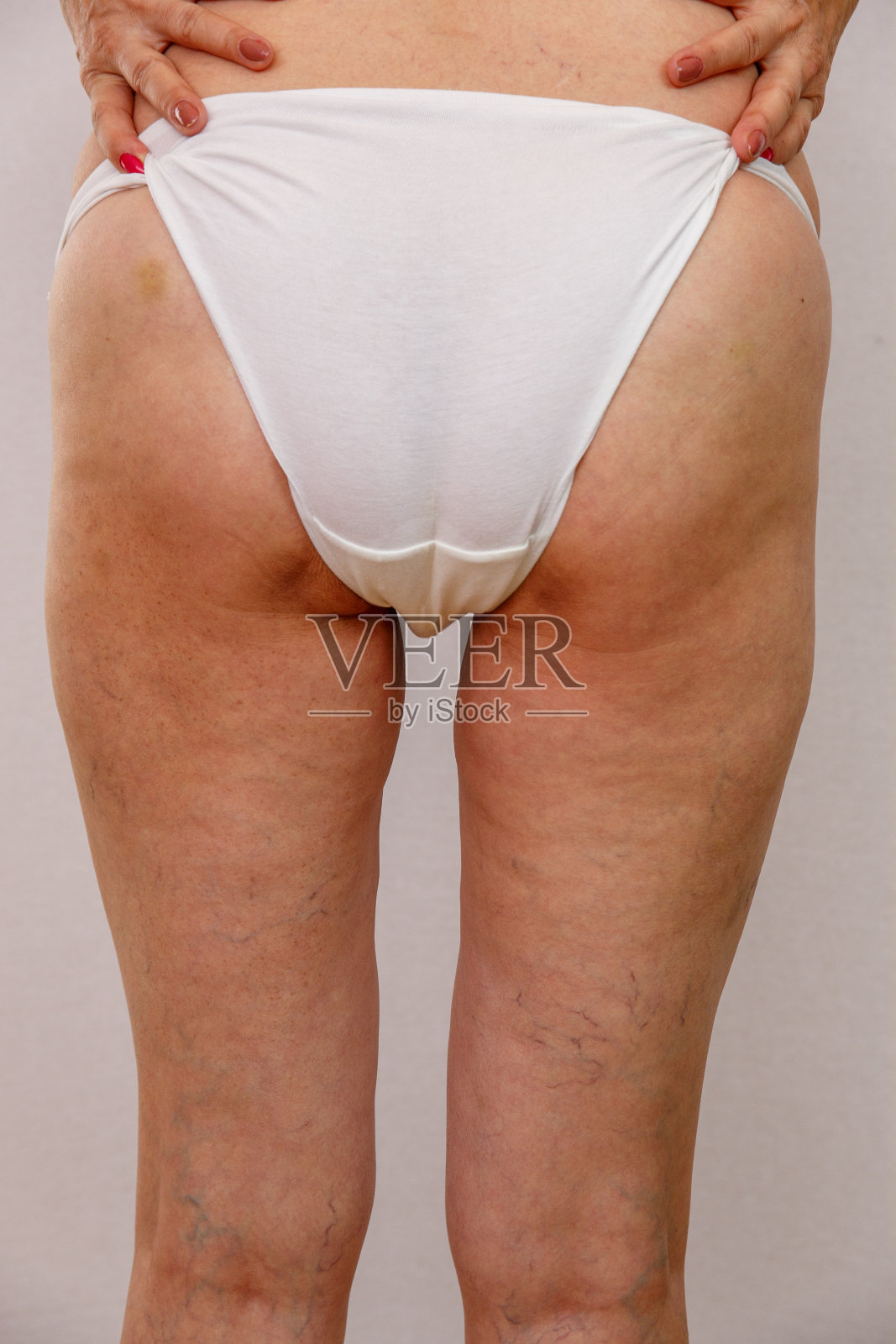 老年妇女出现静脉曲张照片摄影图片