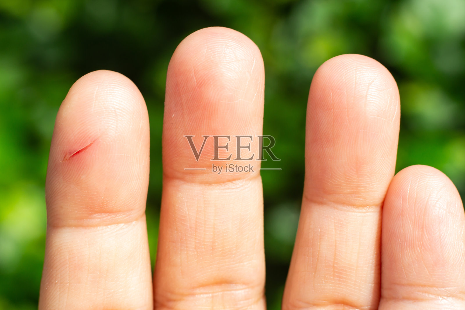 女性食指和手部疤痕皮肤,特写和微距拍摄,亚洲人身体皮肤部分,保健概念,博凯绿色花园背景照片摄影图片