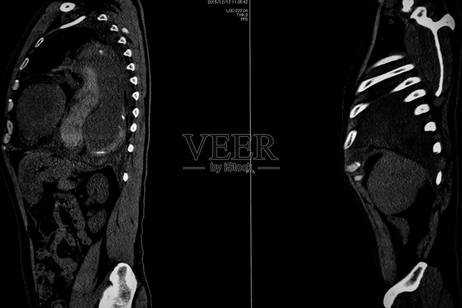 计算机断层血管造影:CTA全身扫描与三维重建。ct血管造影以确定血管疾病/创伤。技术的概念。照片摄影图片