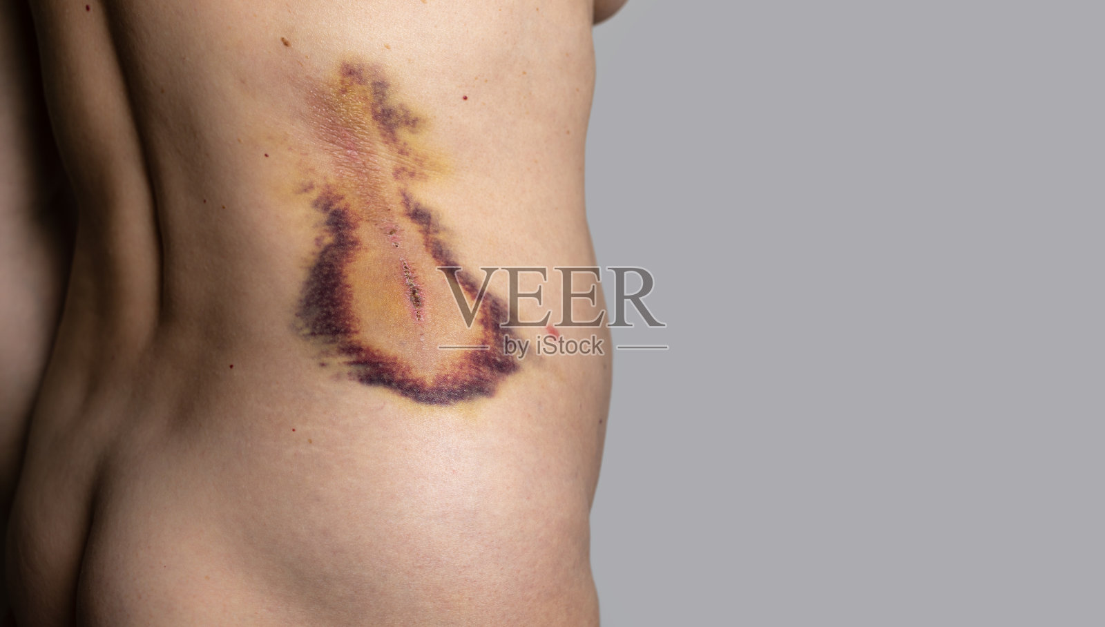 大的痛苦的血肿照片摄影图片