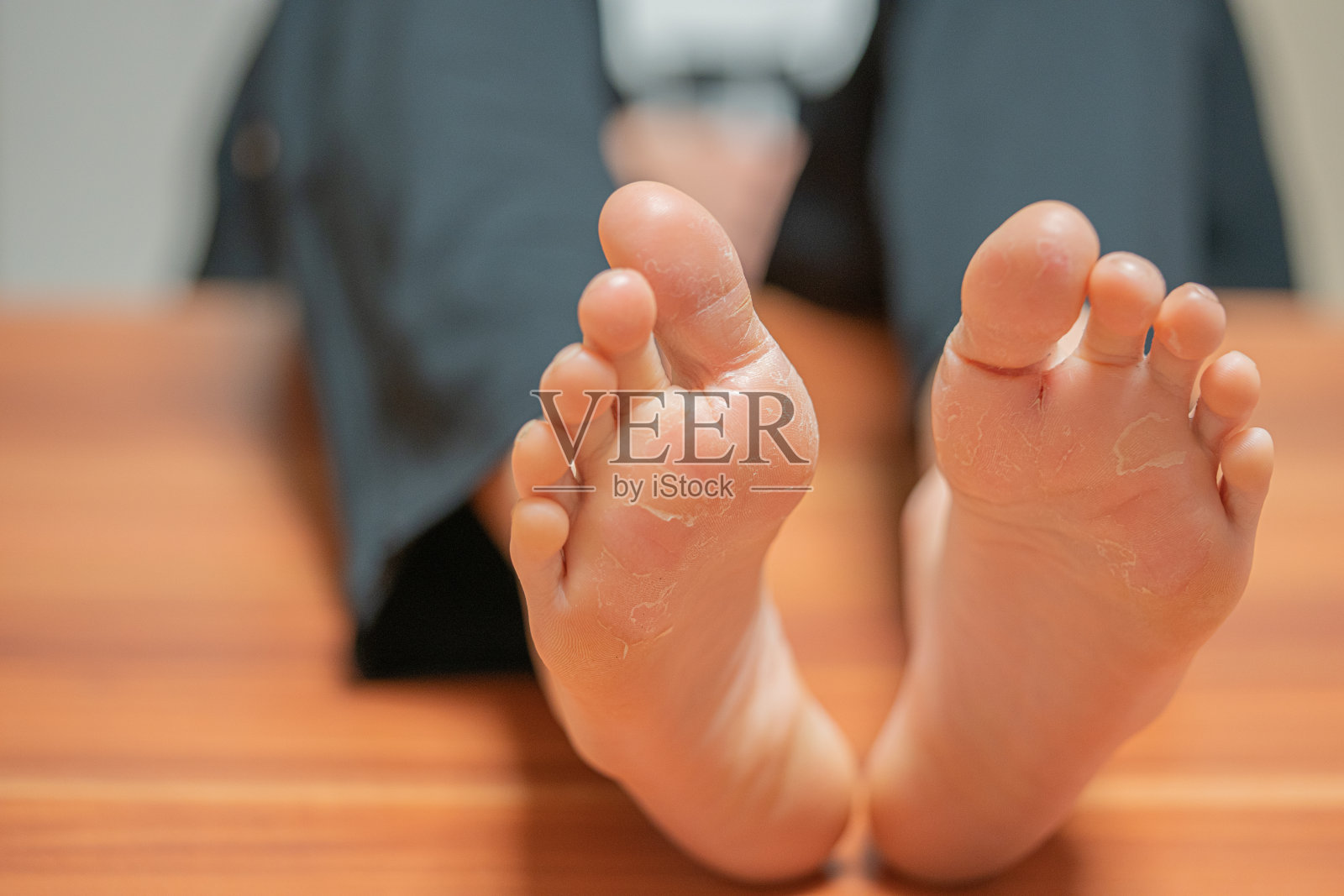 一双脚上的皮肤由于湿疹而脱落照片摄影图片