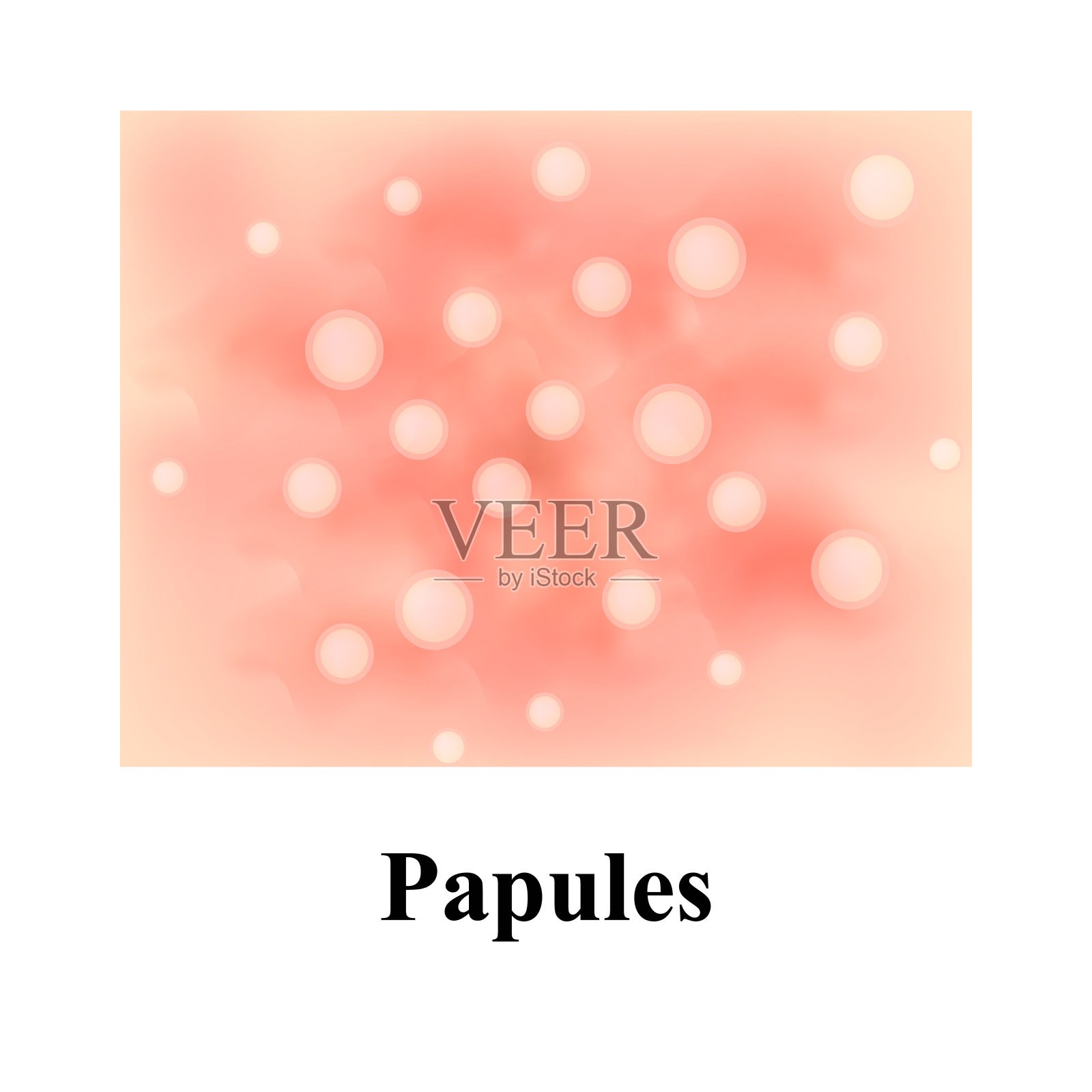 皮肤上的丘疹。粉刺。皮肤上的粉刺。信息图。矢量插图。插画图片素材