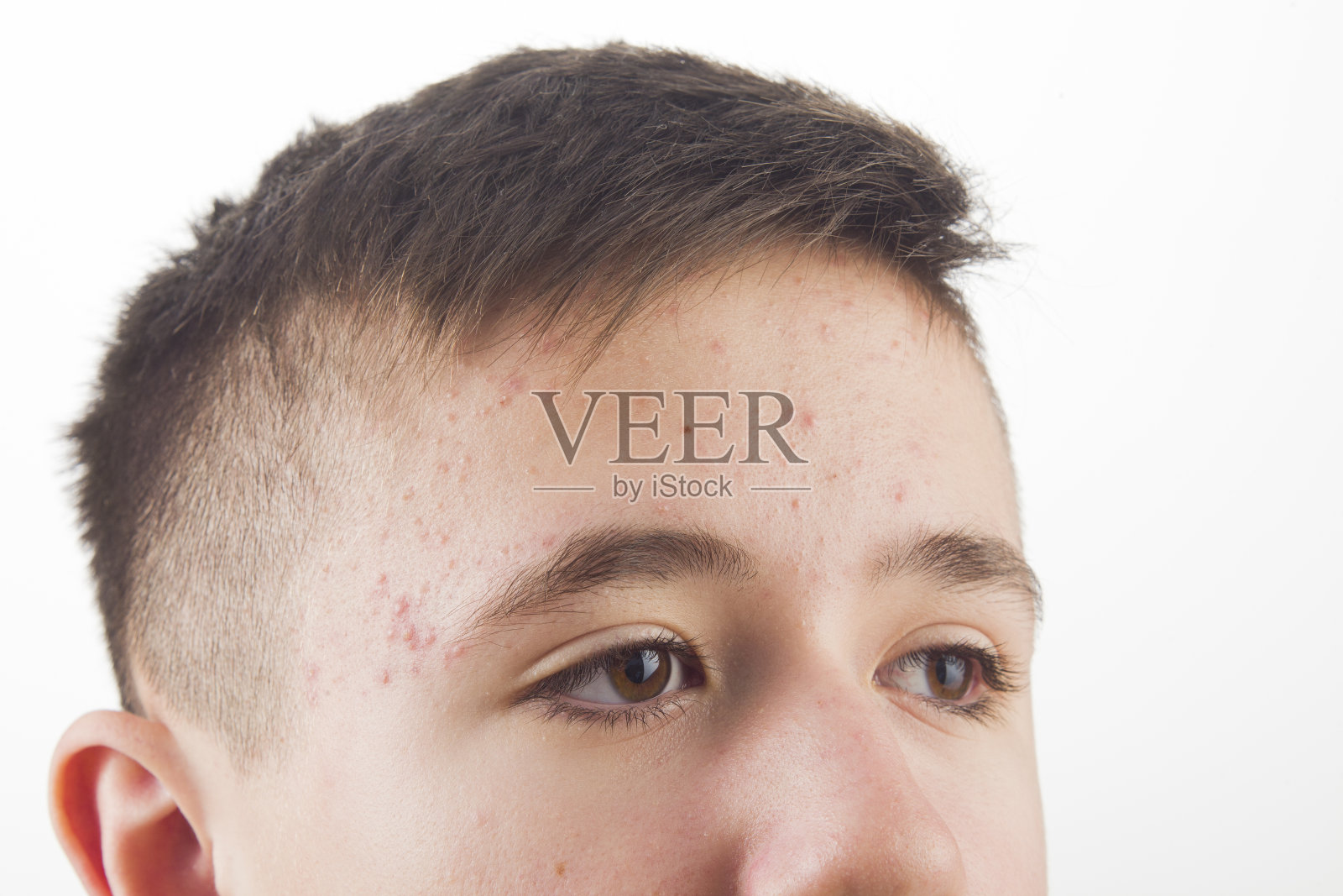 痤疮:13岁青少年的青春期问题照片摄影图片