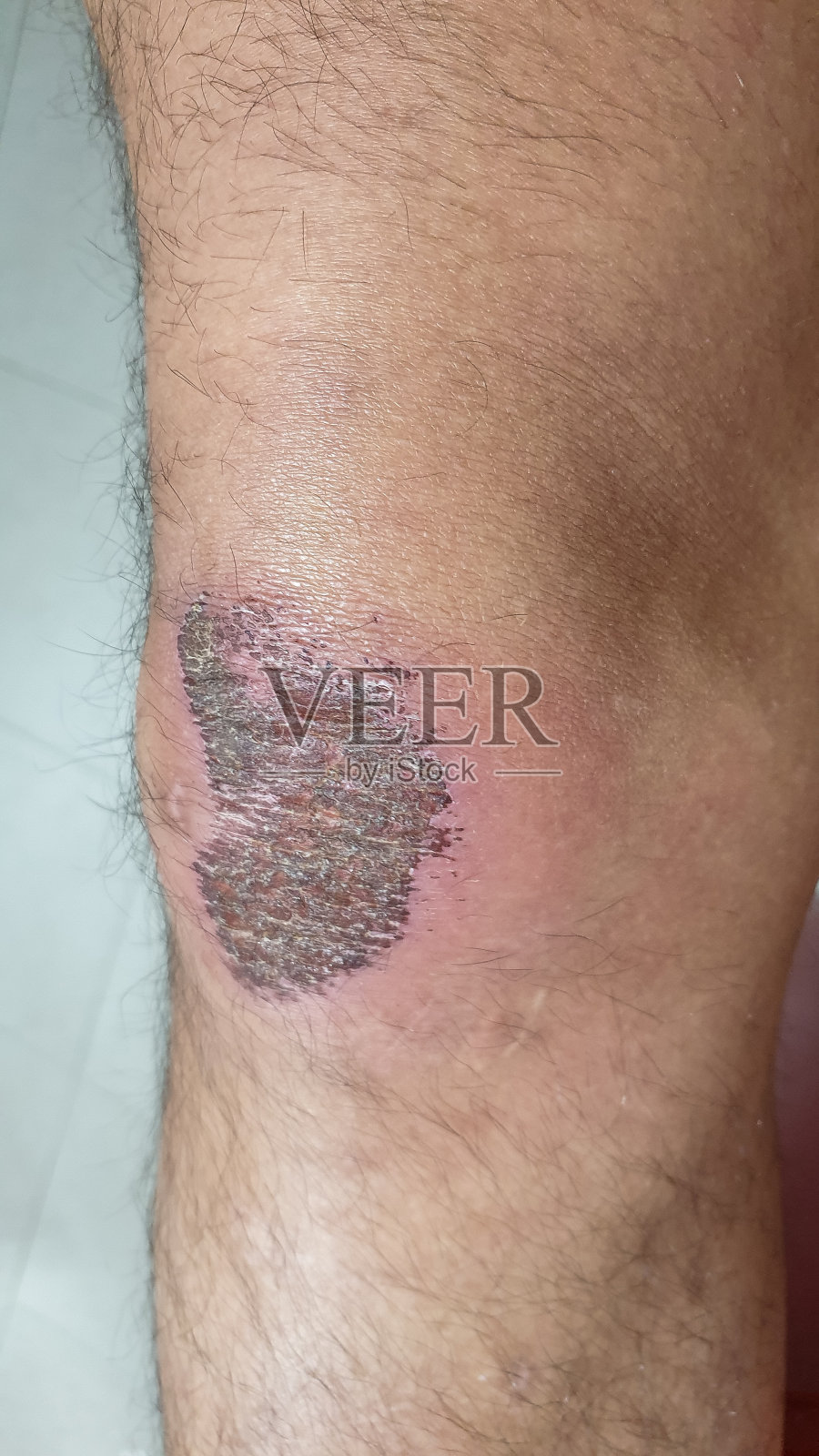 膝盖伤口结痂照片摄影图片