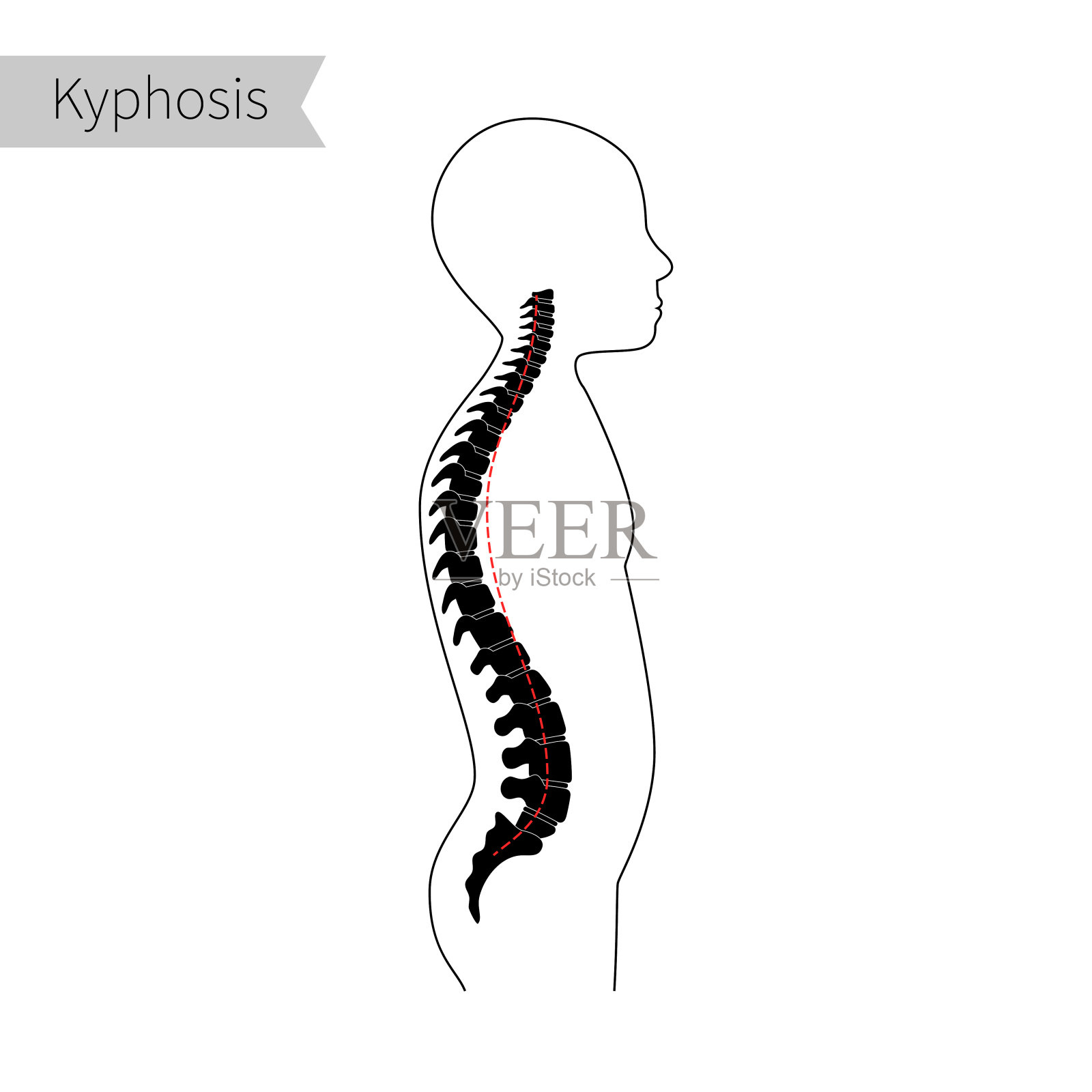 后凸扁平矢量图解。插画图片素材