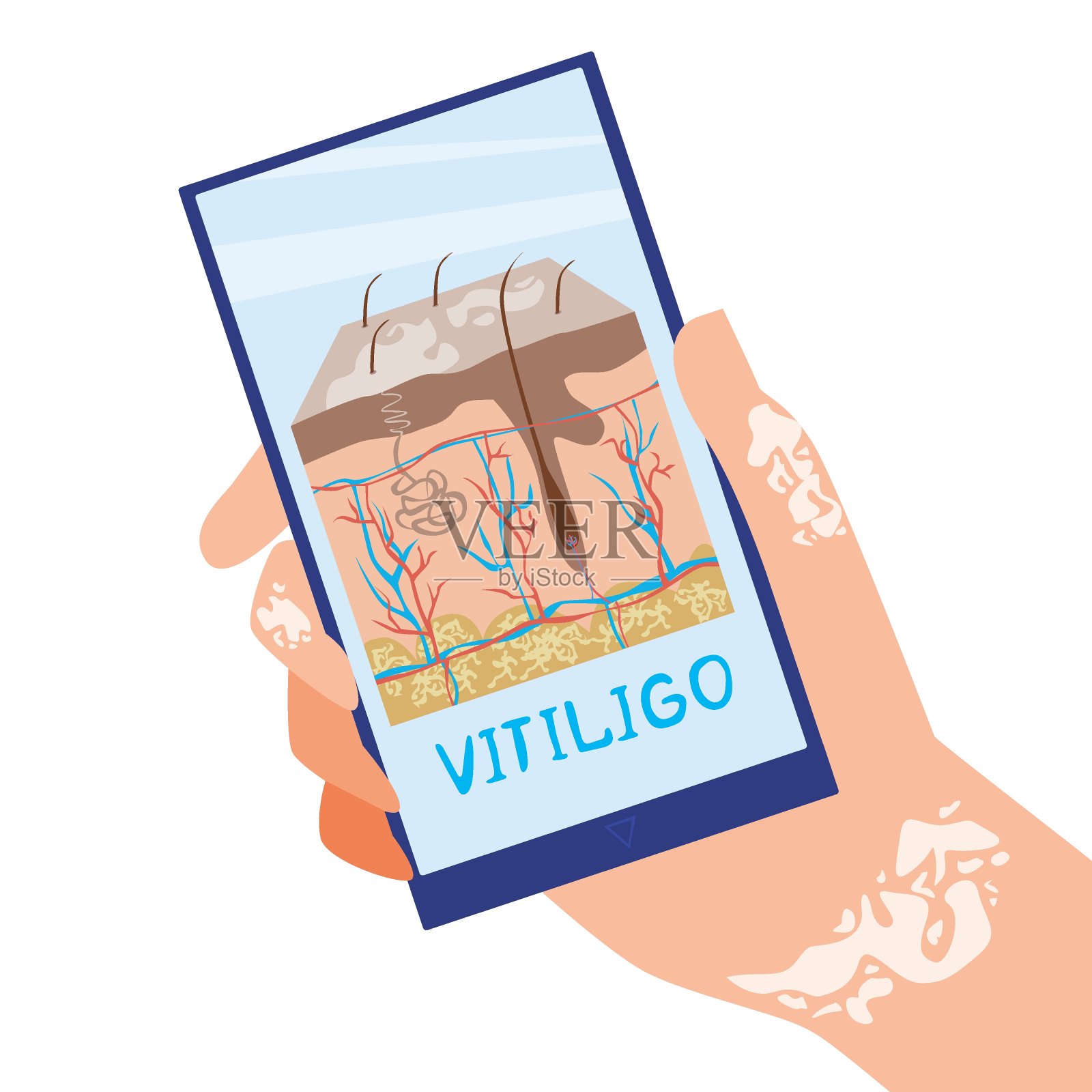 智能手机和手与白癜风和皮肤细胞的解剖结构在屏幕上,平面股票矢量插图与剖面皮肤作为获取信息和白癜风的概念插画图片素材