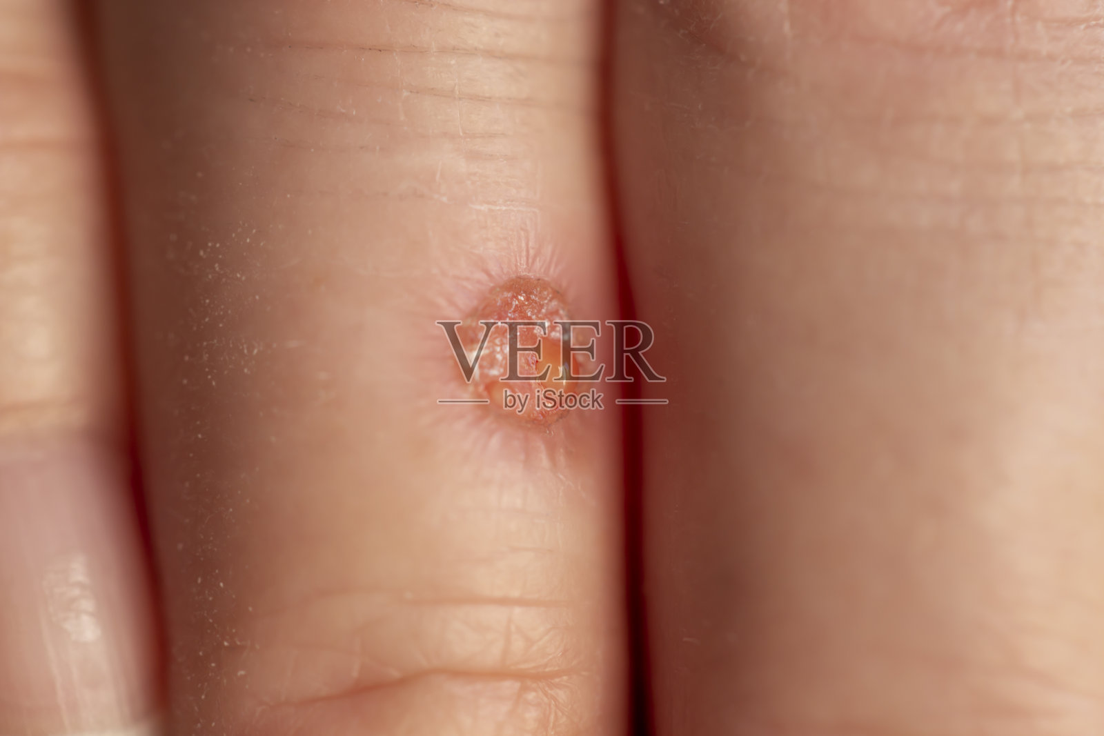 手指伤口细节照片摄影图片