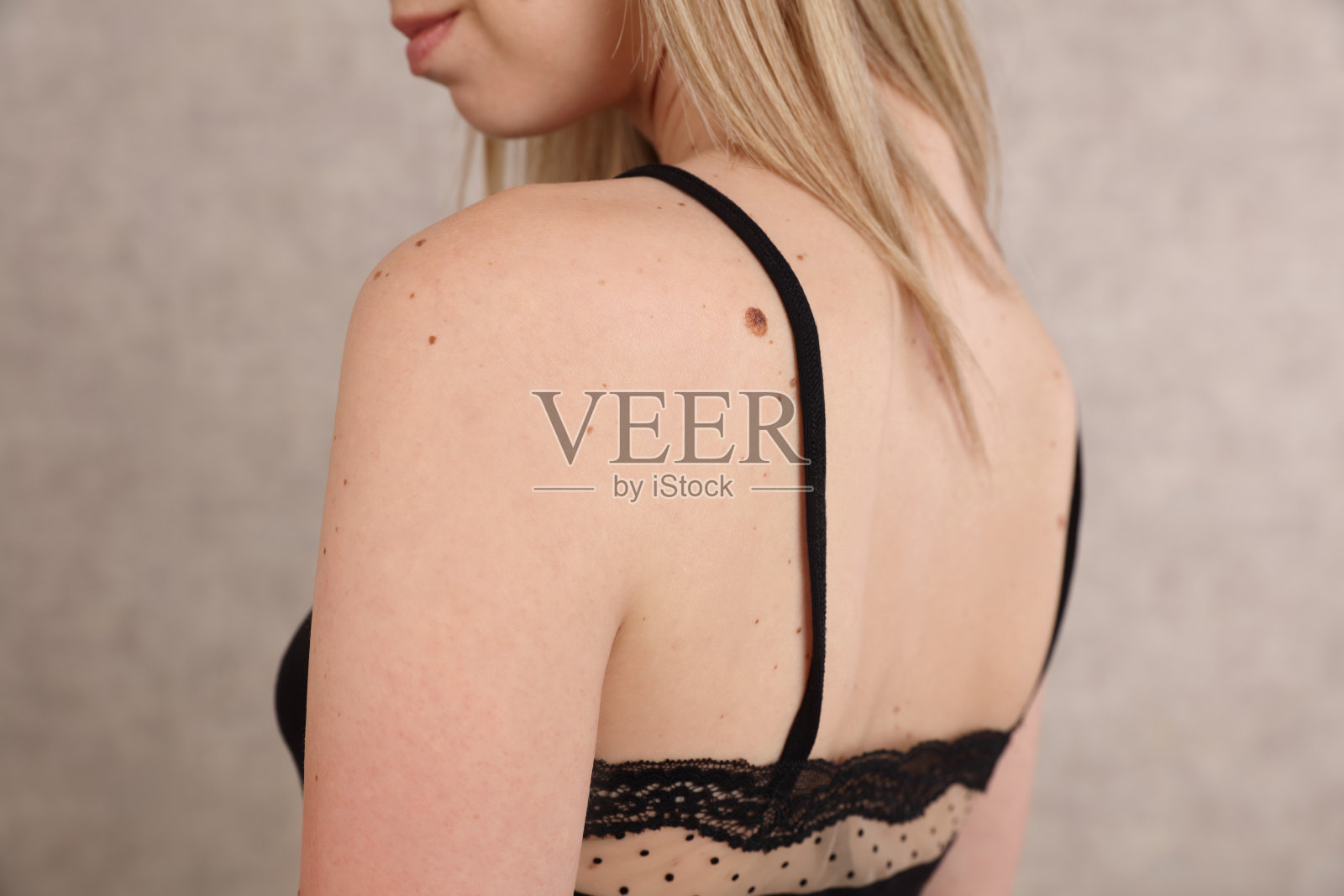 良性痣:背部和面部有胎记的女性照片摄影图片