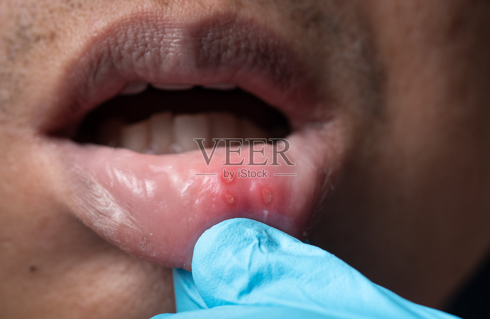 亚洲男子口疮性口炎的闭口照片摄影图片