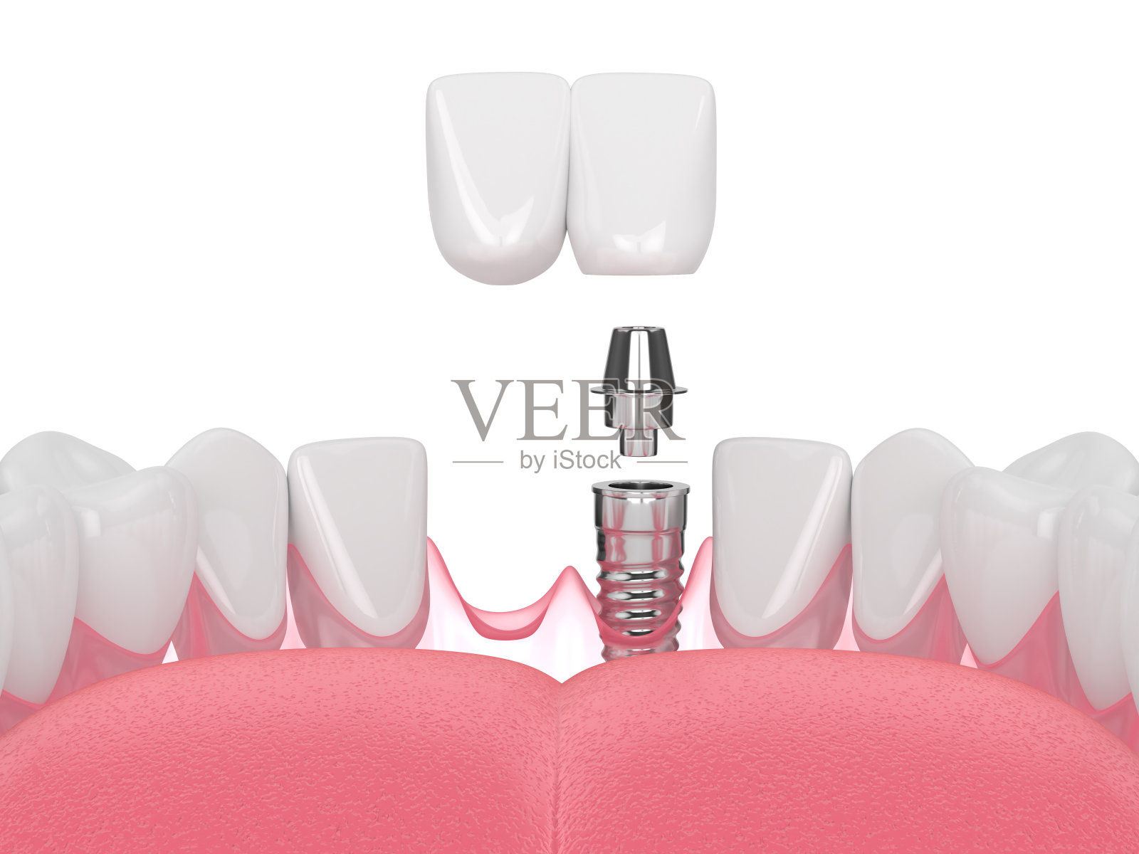 3d渲染颌骨与牙门牙悬臂桥照片摄影图片