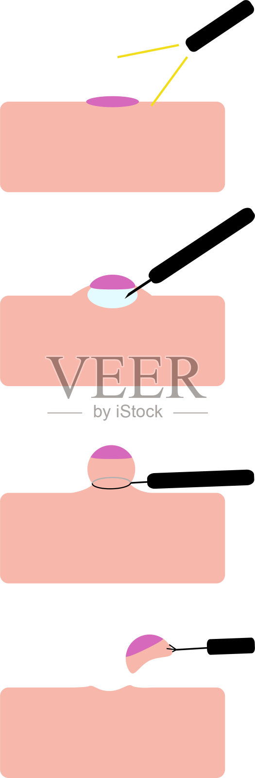 切除息肉的外科手术插画图片素材