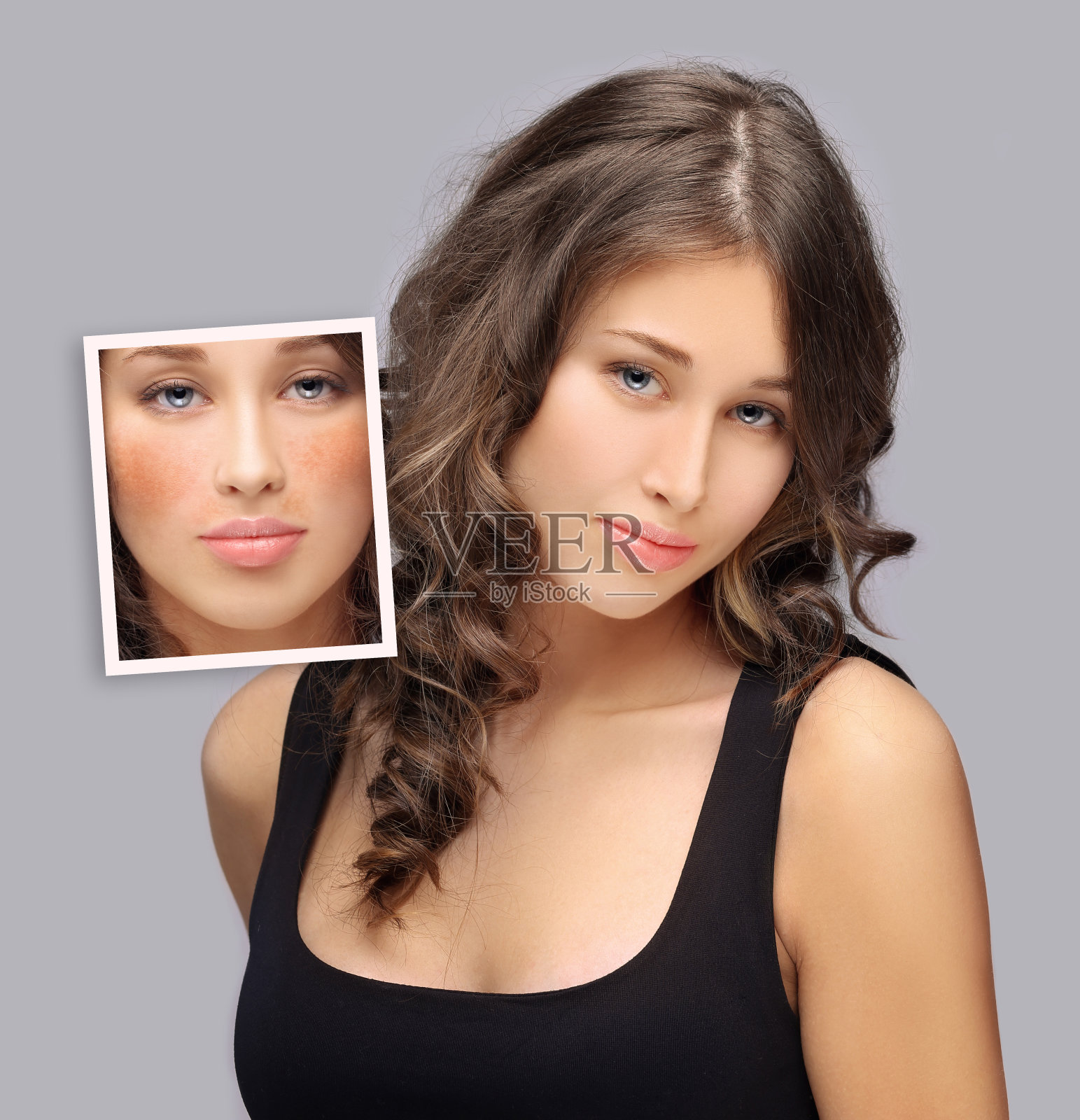 黑斑、雀斑、色素沉着(黄褐斑或黄褐斑)照片摄影图片