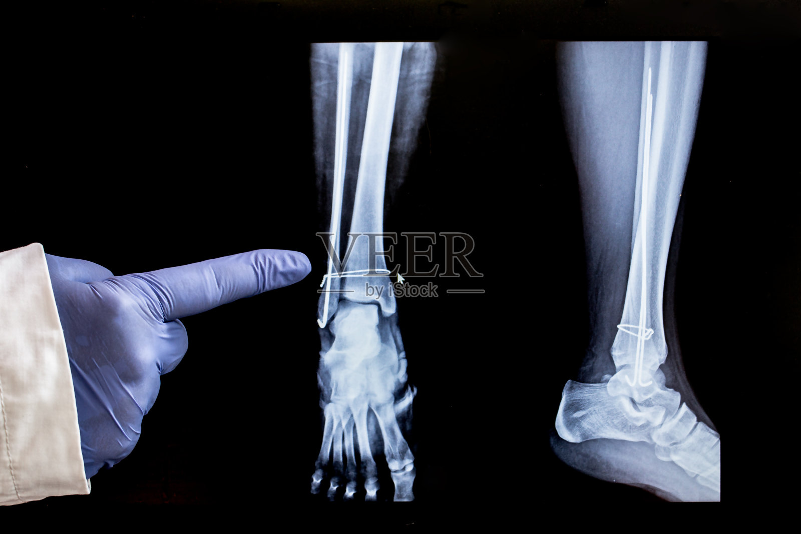 腿部手术后的x光片照片摄影图片