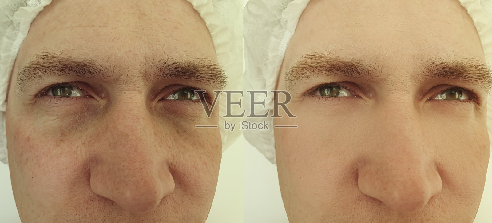 男子脸部皱纹治疗前后拼贴照片摄影图片