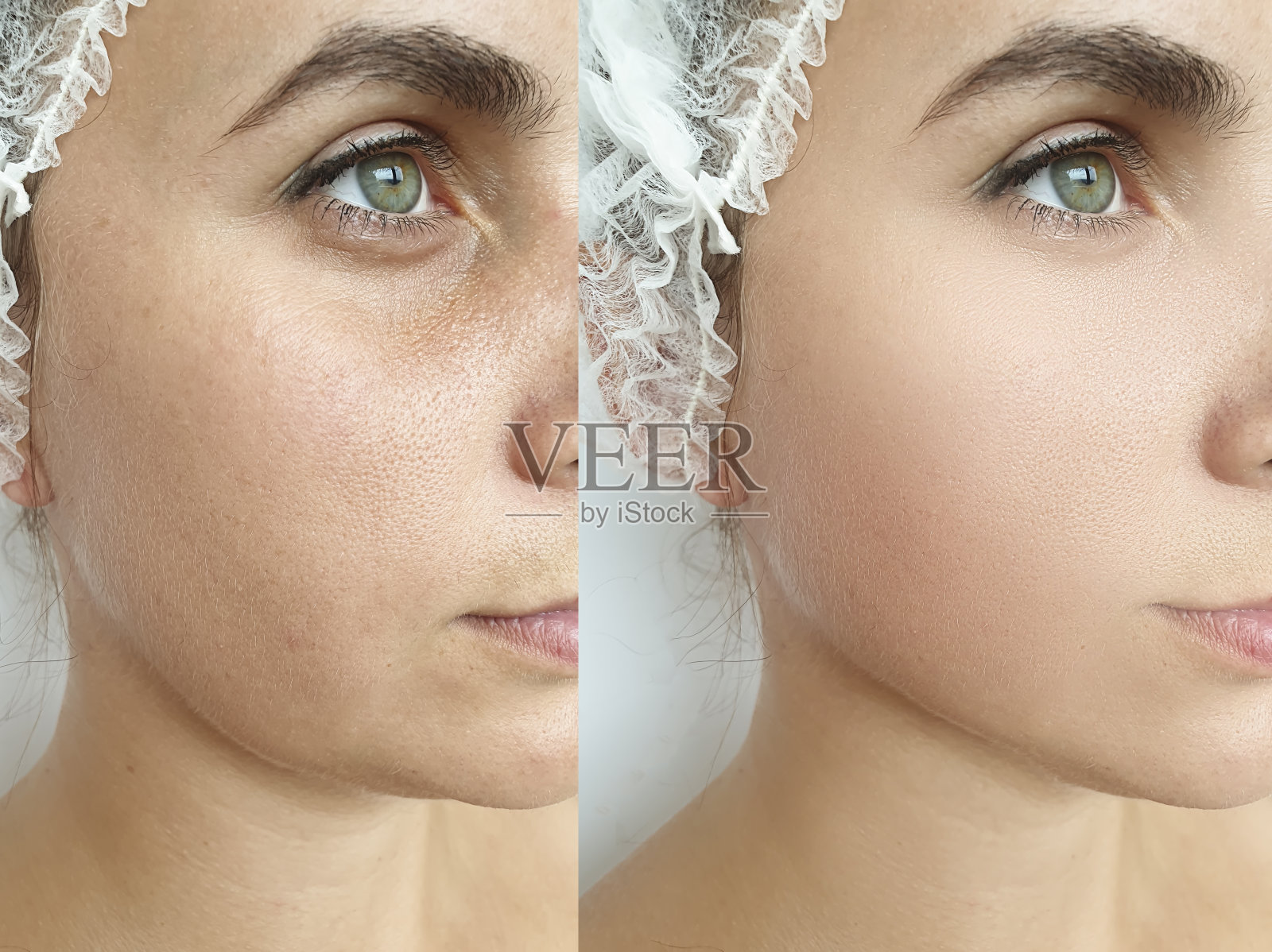 女人脸部皱纹治疗前后拼贴照片摄影图片