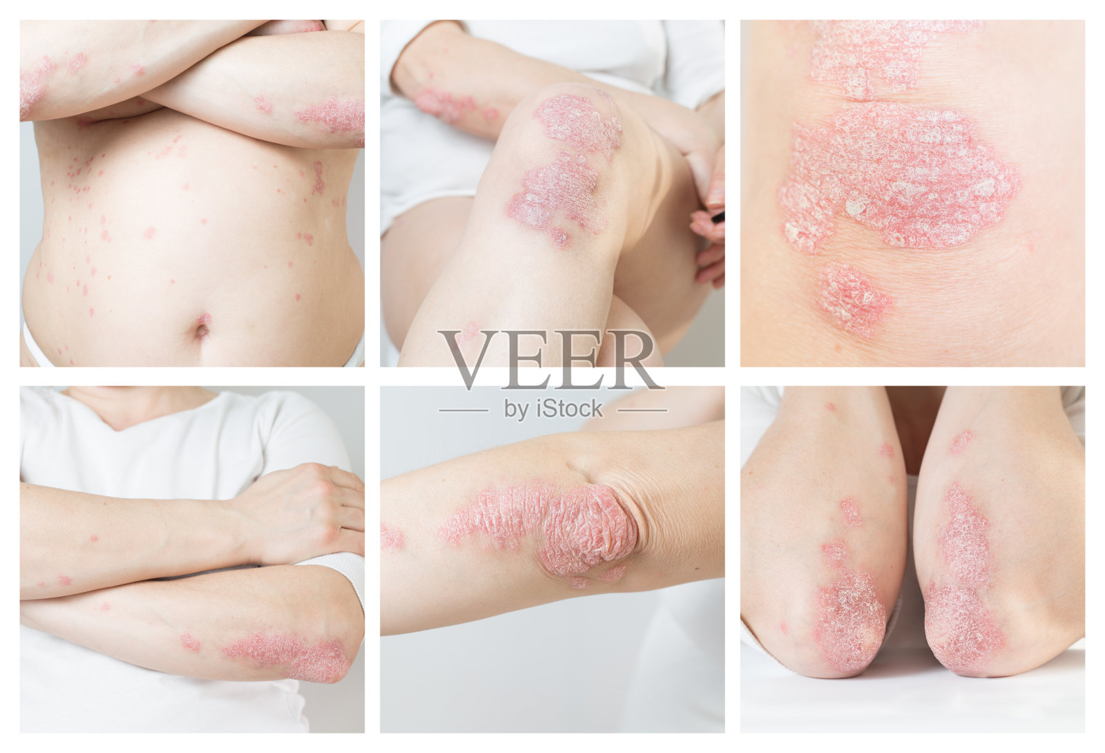 多照片,在女性身体的各个部分的急性猪脓疮的拼贴。一种自身免疫的无法治愈的皮肤病大的红色,发炎的鳞状皮疹照片摄影图片