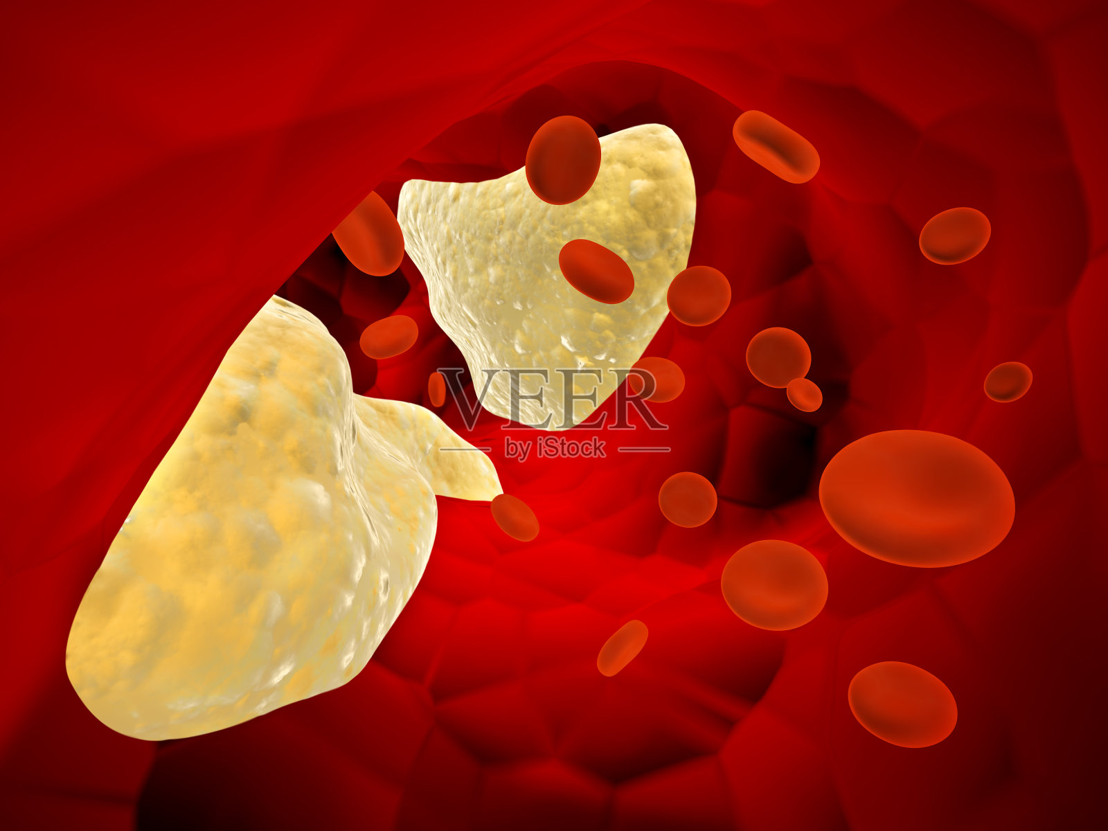 动脉(动脉粥样硬化)和红细胞中的胆固醇斑块照片摄影图片
