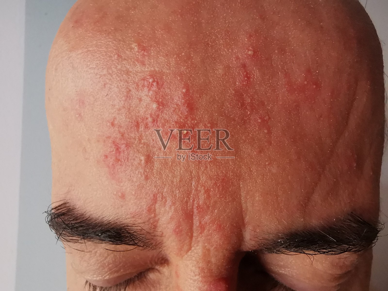 酒渣鼻照片摄影图片