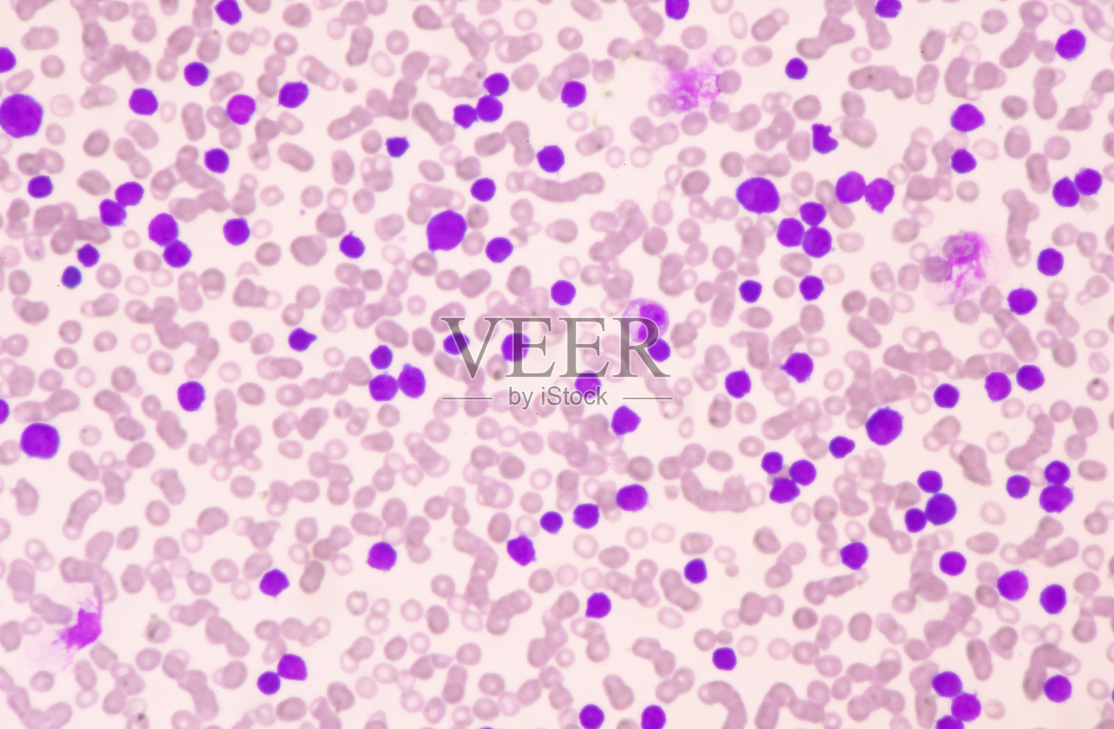 血液涂片中白细胞的中等母细胞。白血病的血的画面。照片摄影图片