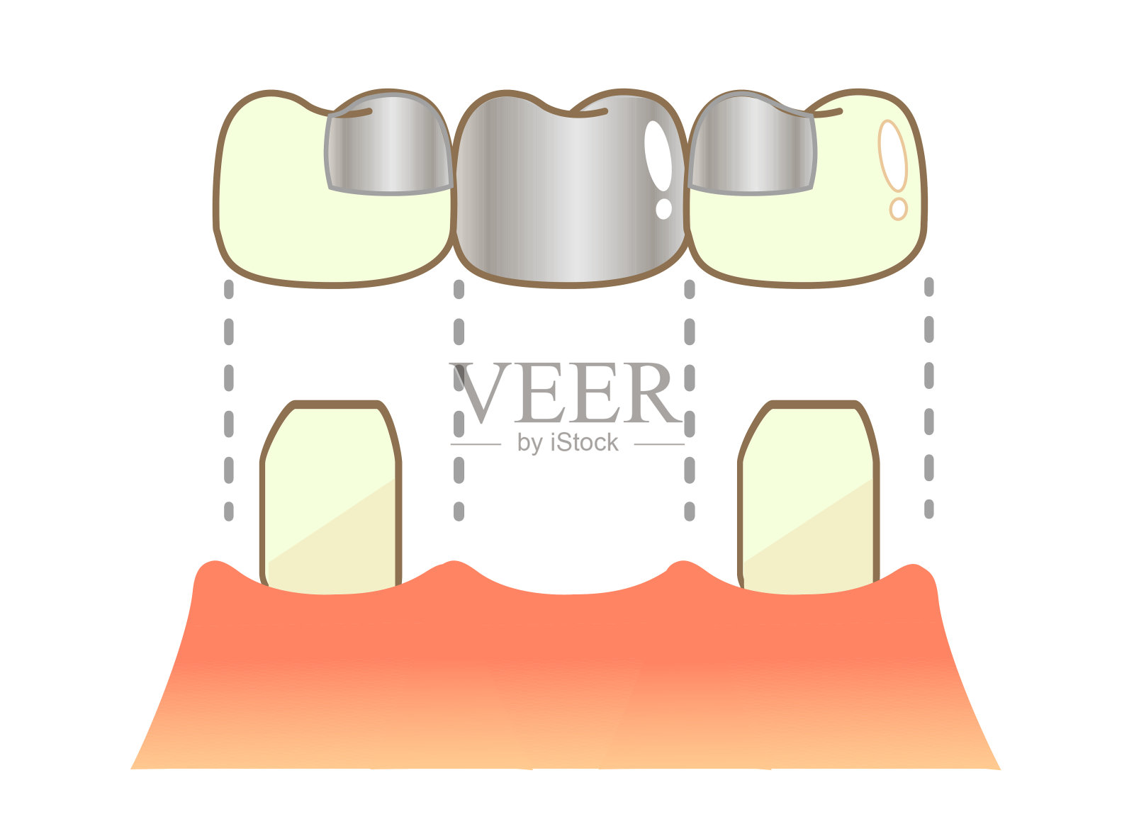义齿冠桥种植体PMTC密封剂龋齿说明复合树脂CR胶粘剂修复方法插画图片素材
