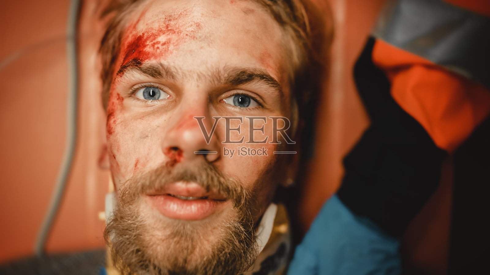 紧张的肖像受伤的年轻胡子男性病人与血瘀伤在他的脸上。受伤男子睁开眼睛躺在医院担架上。他很震惊,很理智,很高兴活着。照片摄影图片