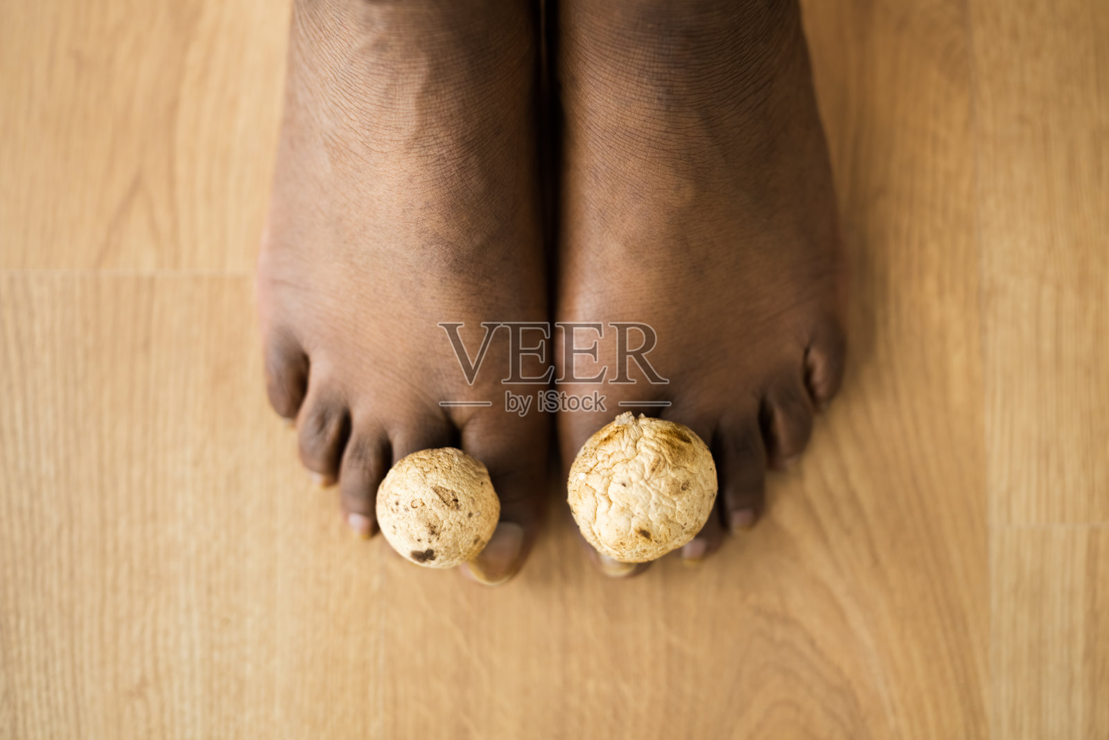 脚趾甲间有真菌蘑菇。臭脚照片摄影图片