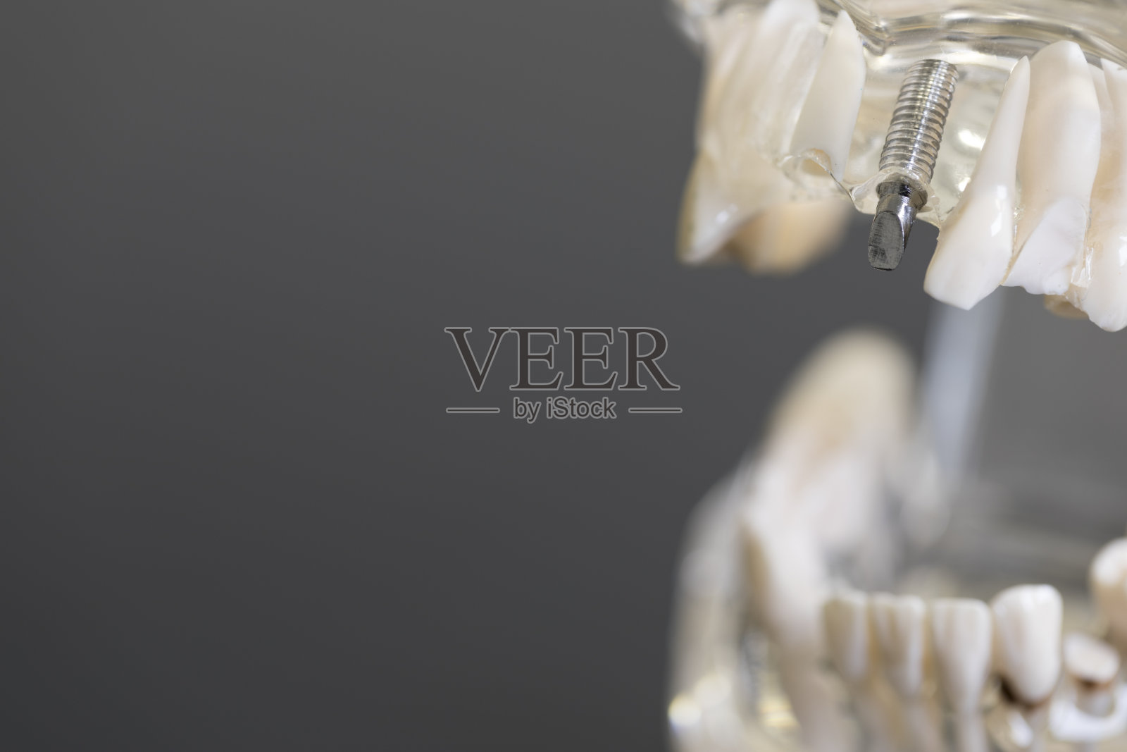 牙科植体模型照片摄影图片