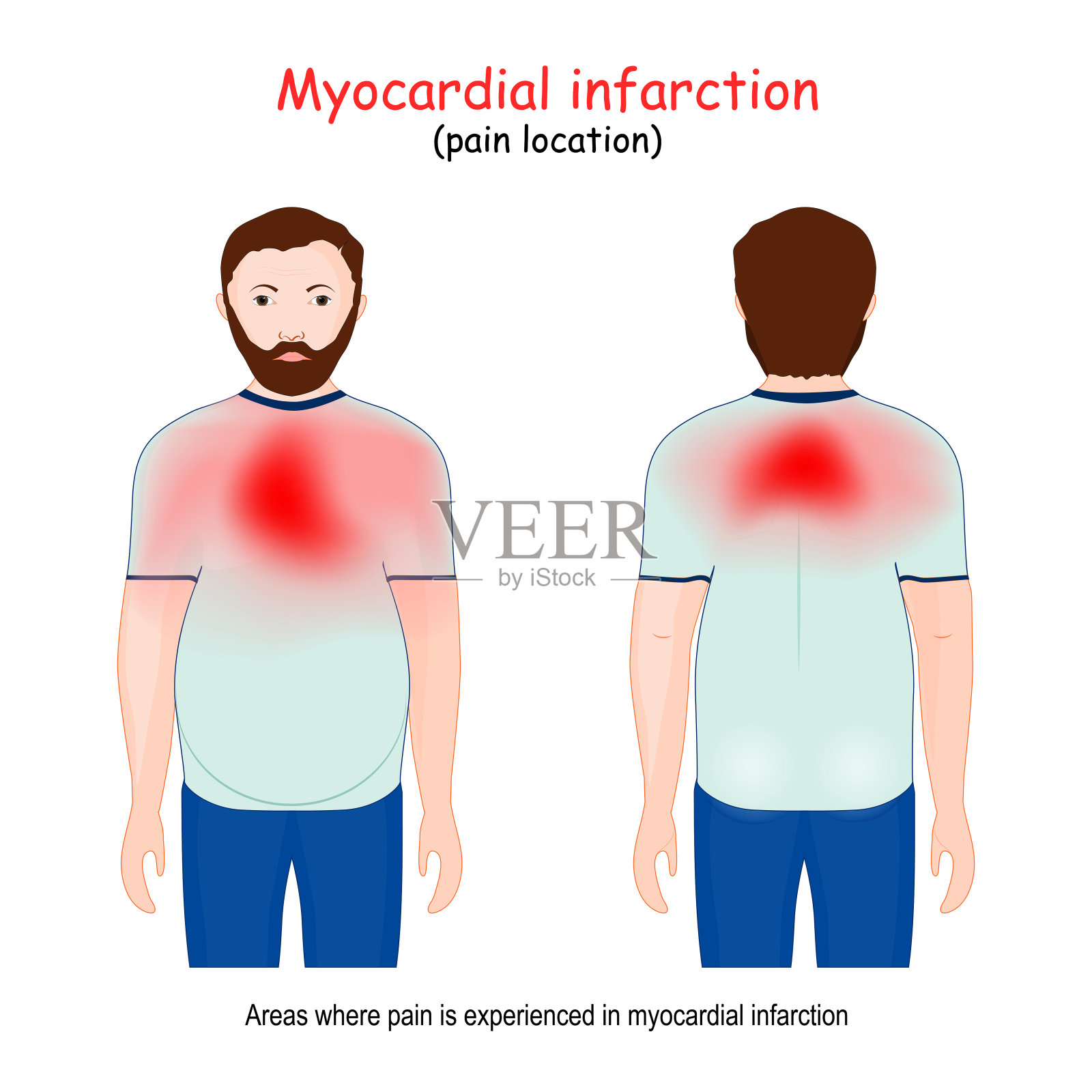 心肌梗死区域。心脏病发作。疼痛的位置插画图片素材