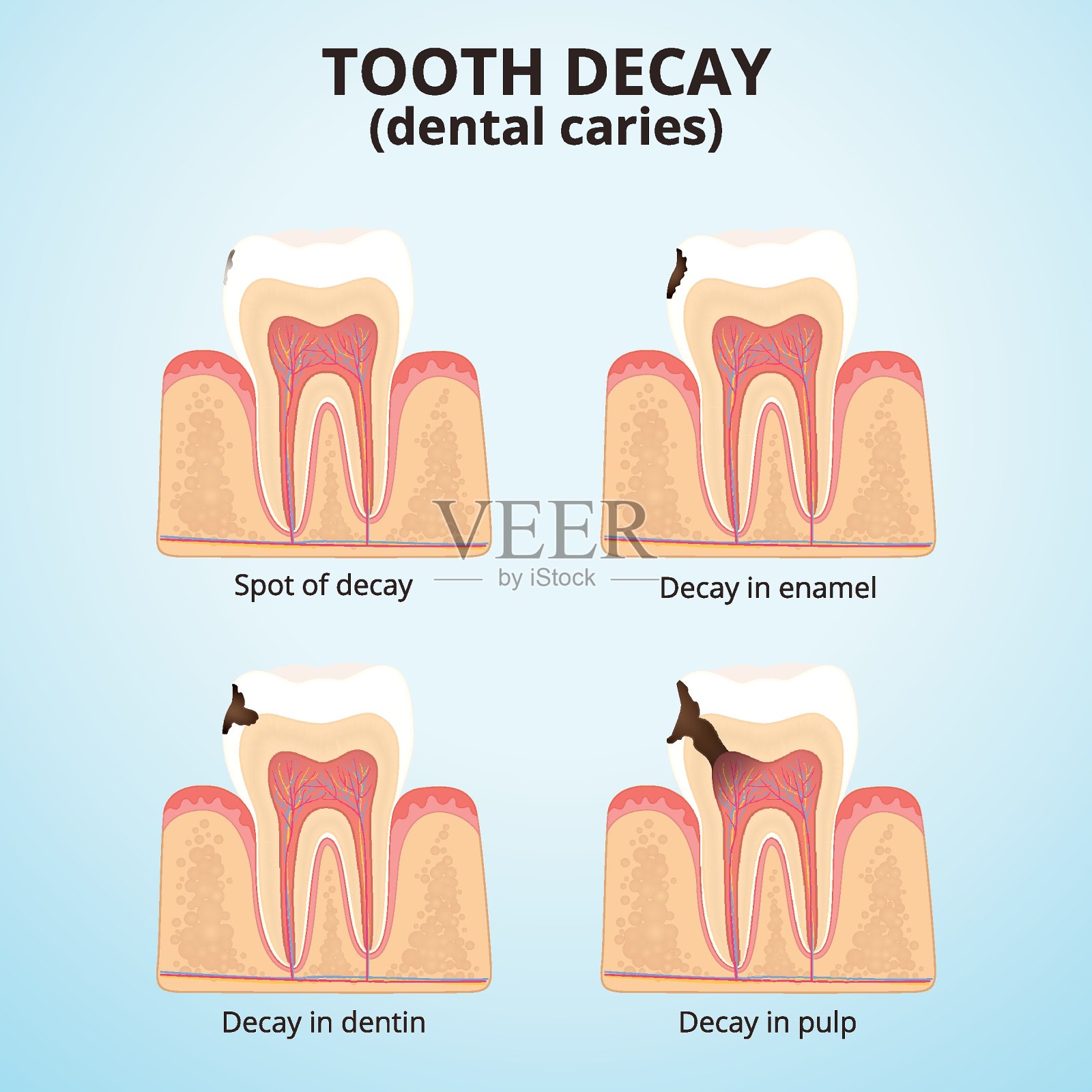 龋齿插画图片素材
